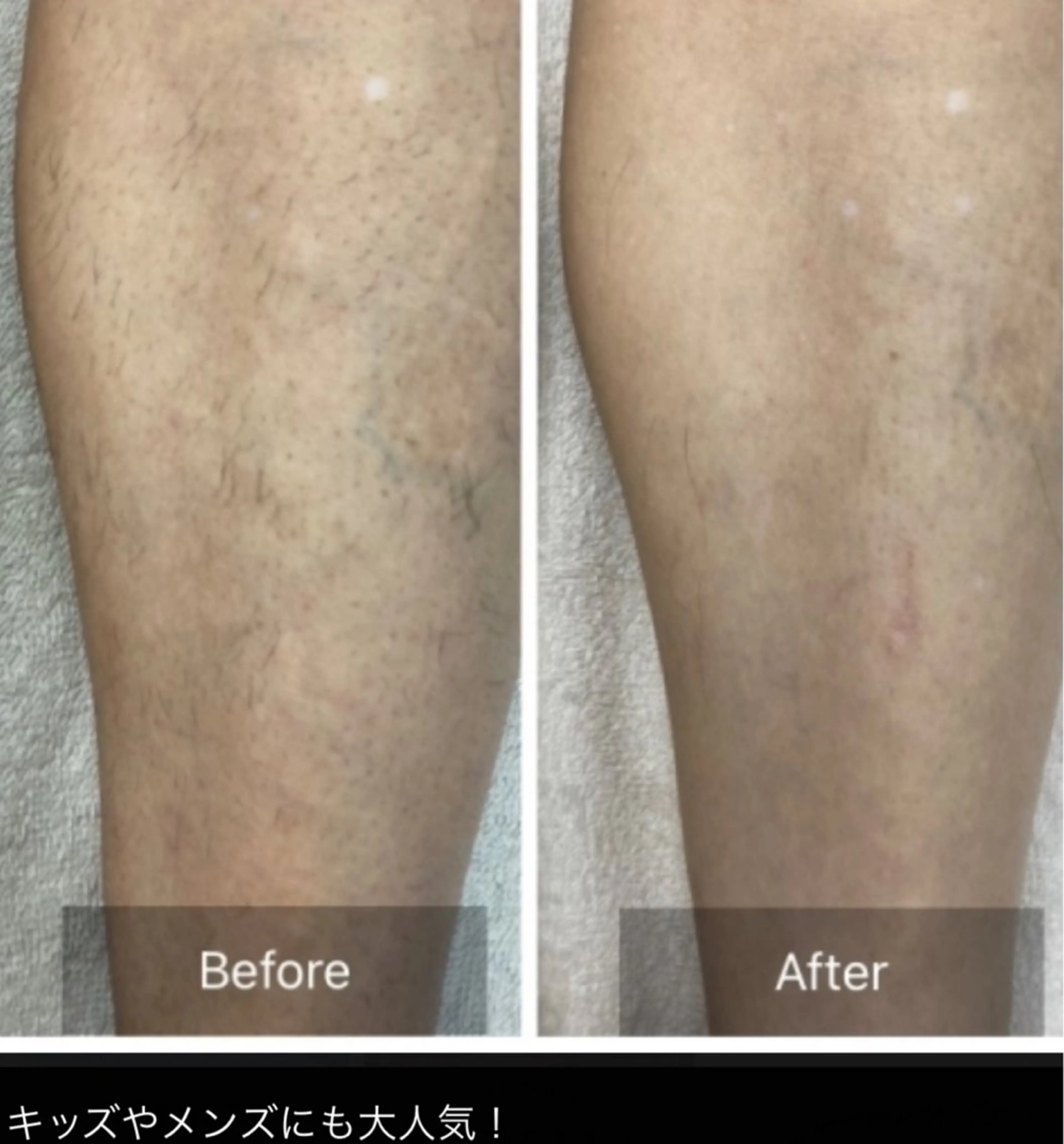 初回光全身のみ（顔VIO無し）の写真