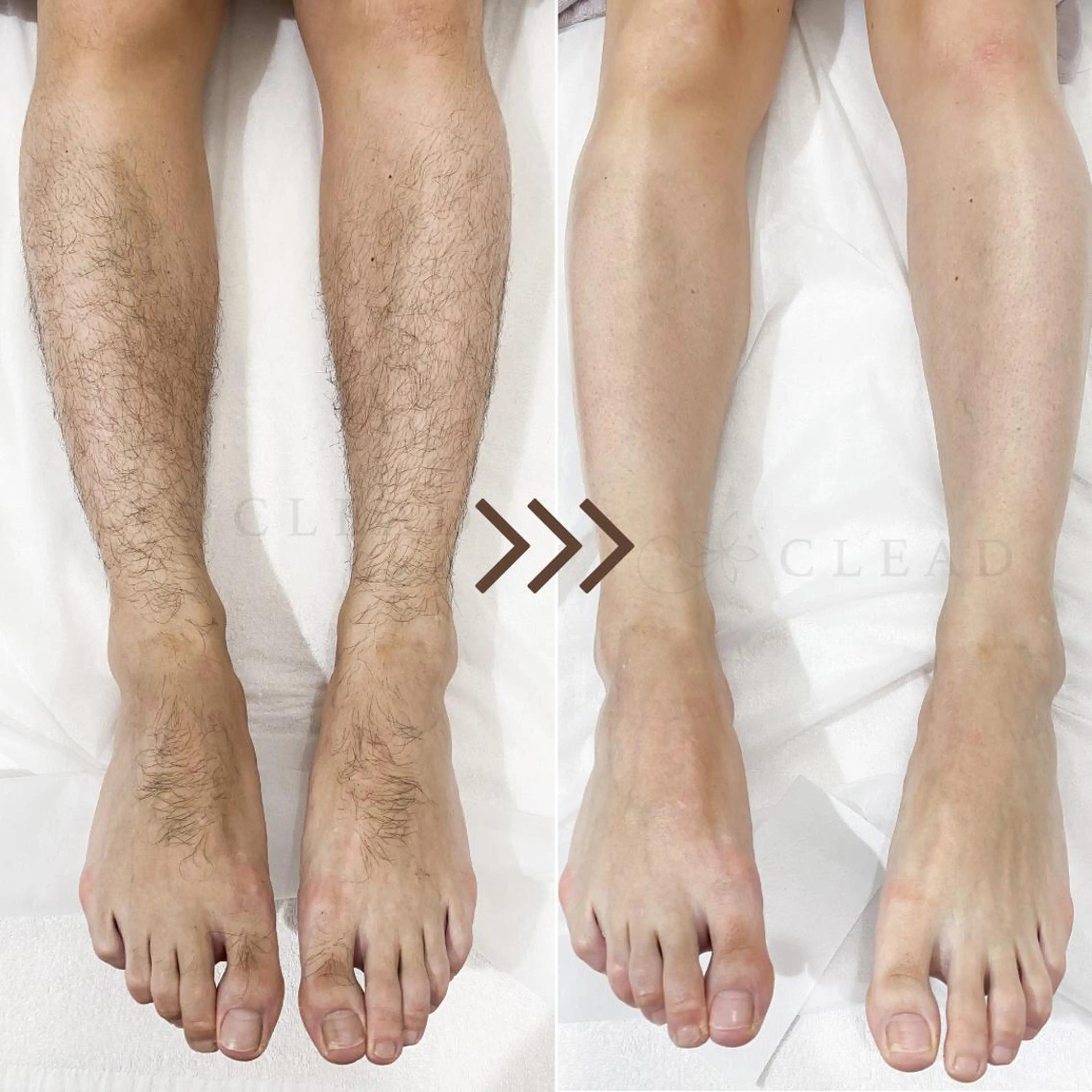 メンズ【チクチクせずにムダ毛ゼロ◎】脚ハーフor腕ハーフワックス脱毛/男性の写真