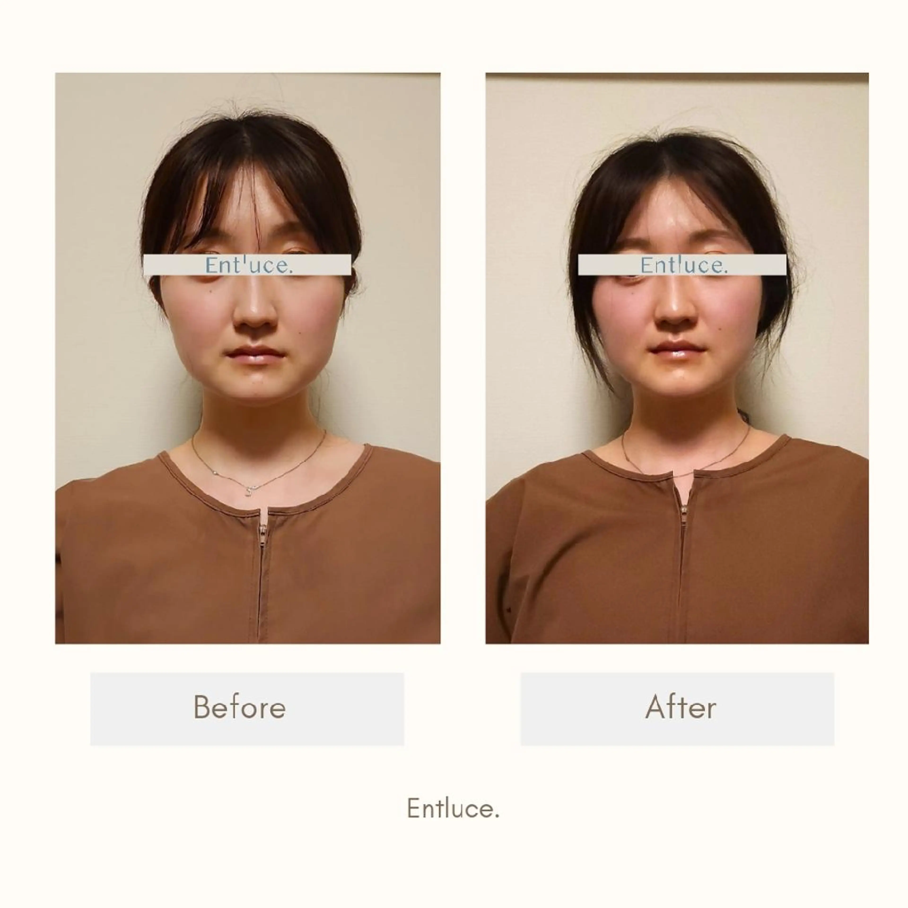 即効⚡小顔美容鍼🪡 むくみたるみ脂肪解消のエステ・リラクイメージ