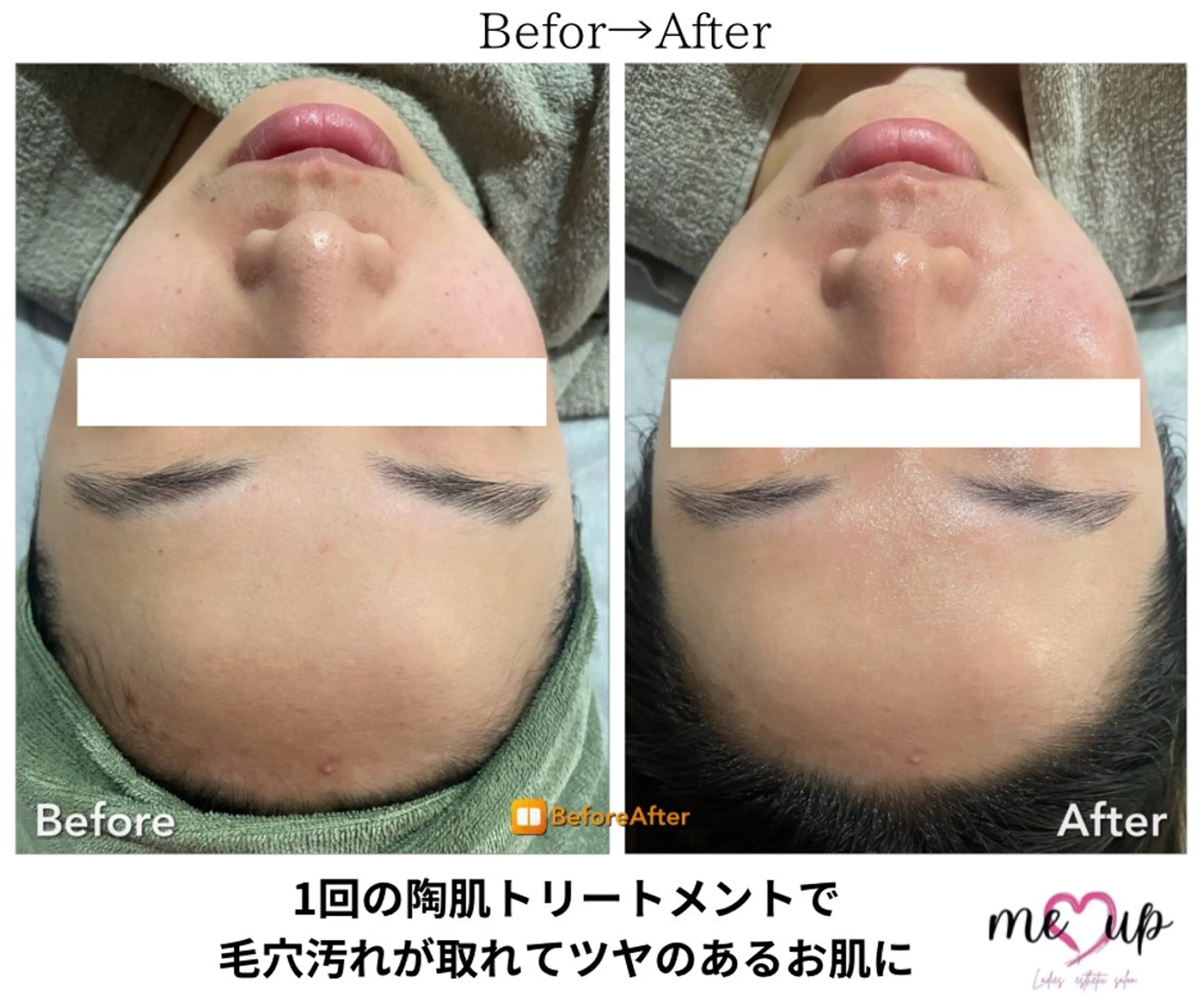 エステ Meupニキビ専門店 背中/ハーブ/肌管理のその他イメージ