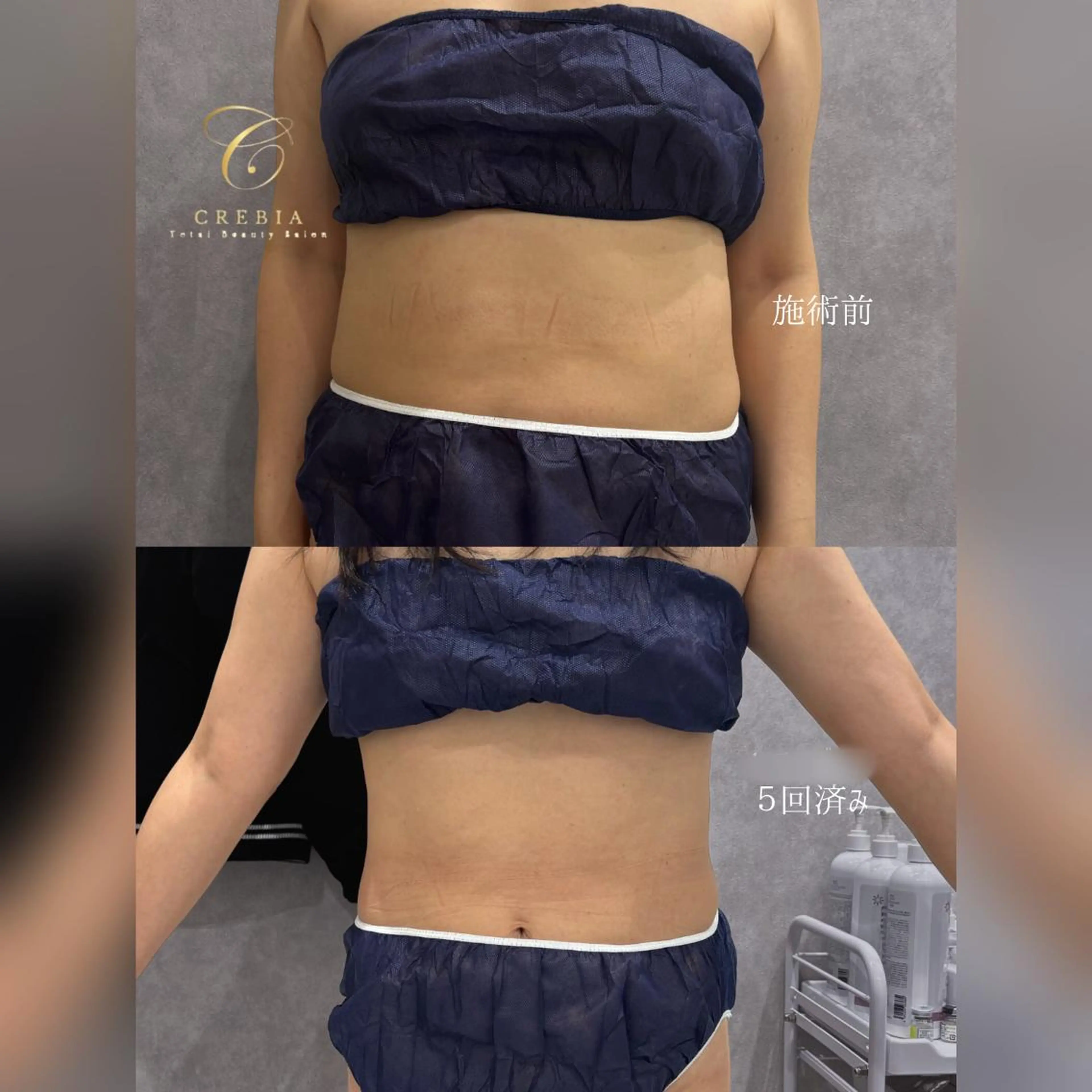 【本気痩せ】脂肪ケア12cc | お腹全体🔥最短引き締め◎の写真