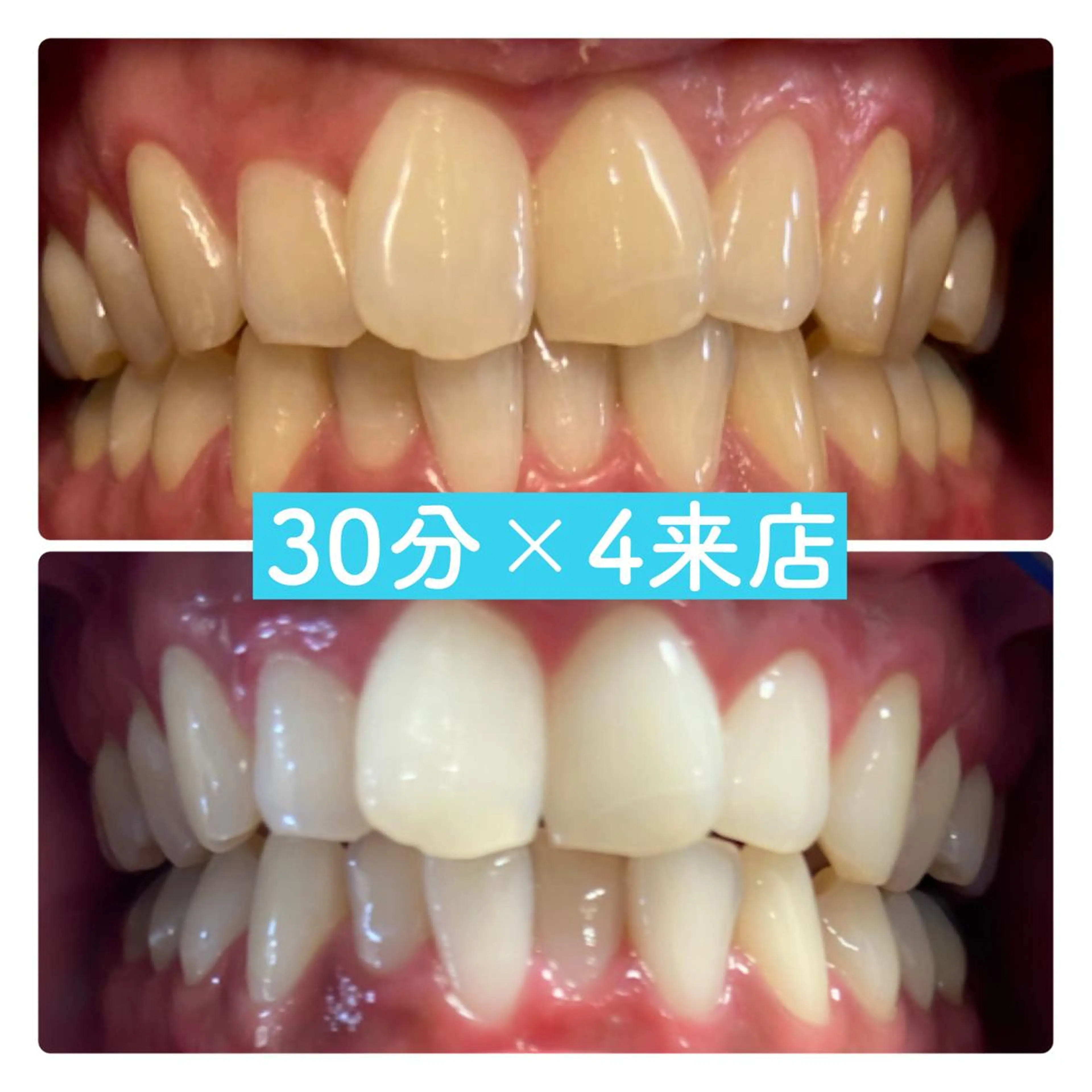 【短期集中】40分×3来店 プラチナホワイトニング🦷✨着色が強い方はこちら💎!の写真