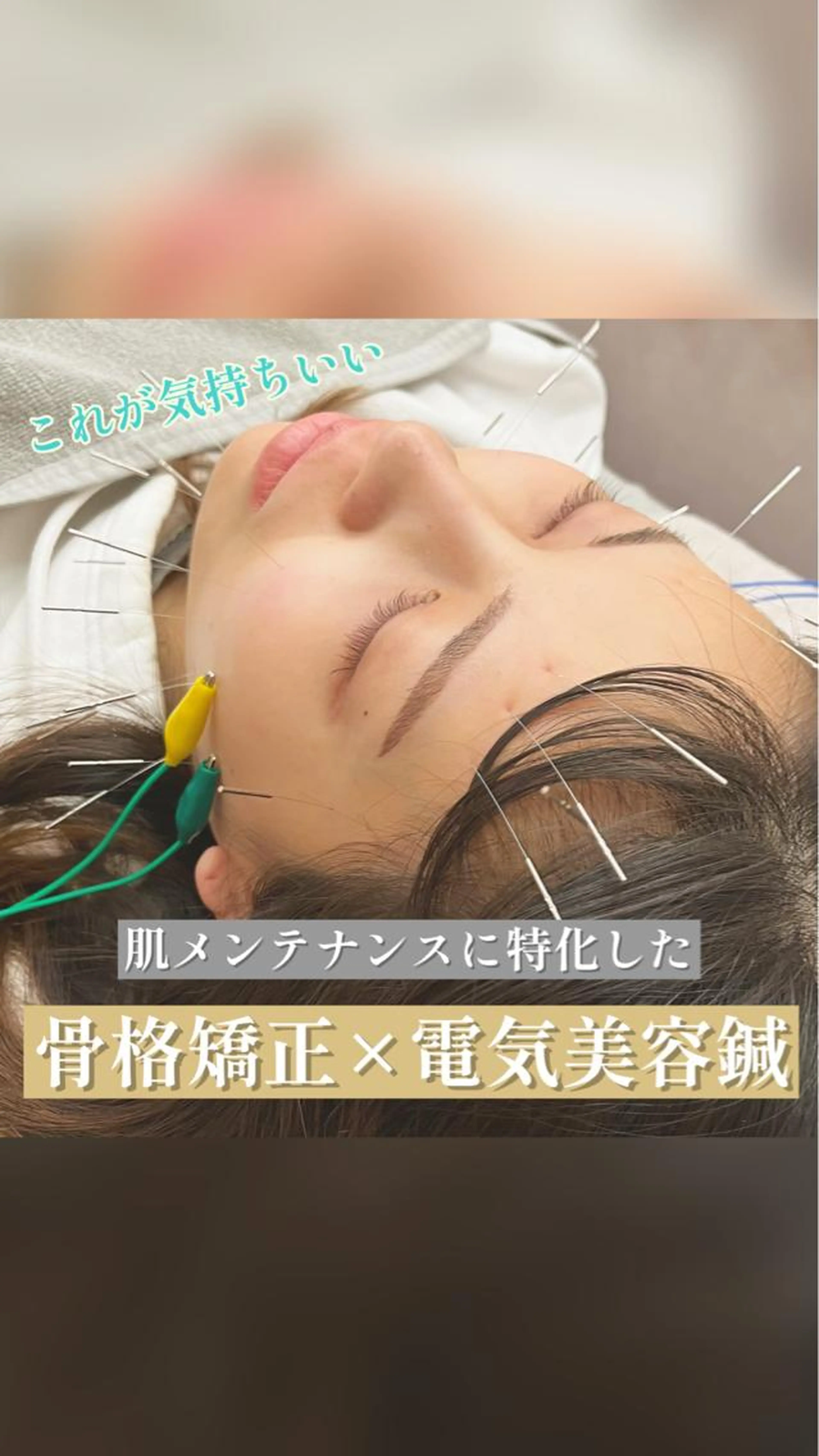 【劇的変化!】むくみ撃退美容鍼✨の写真