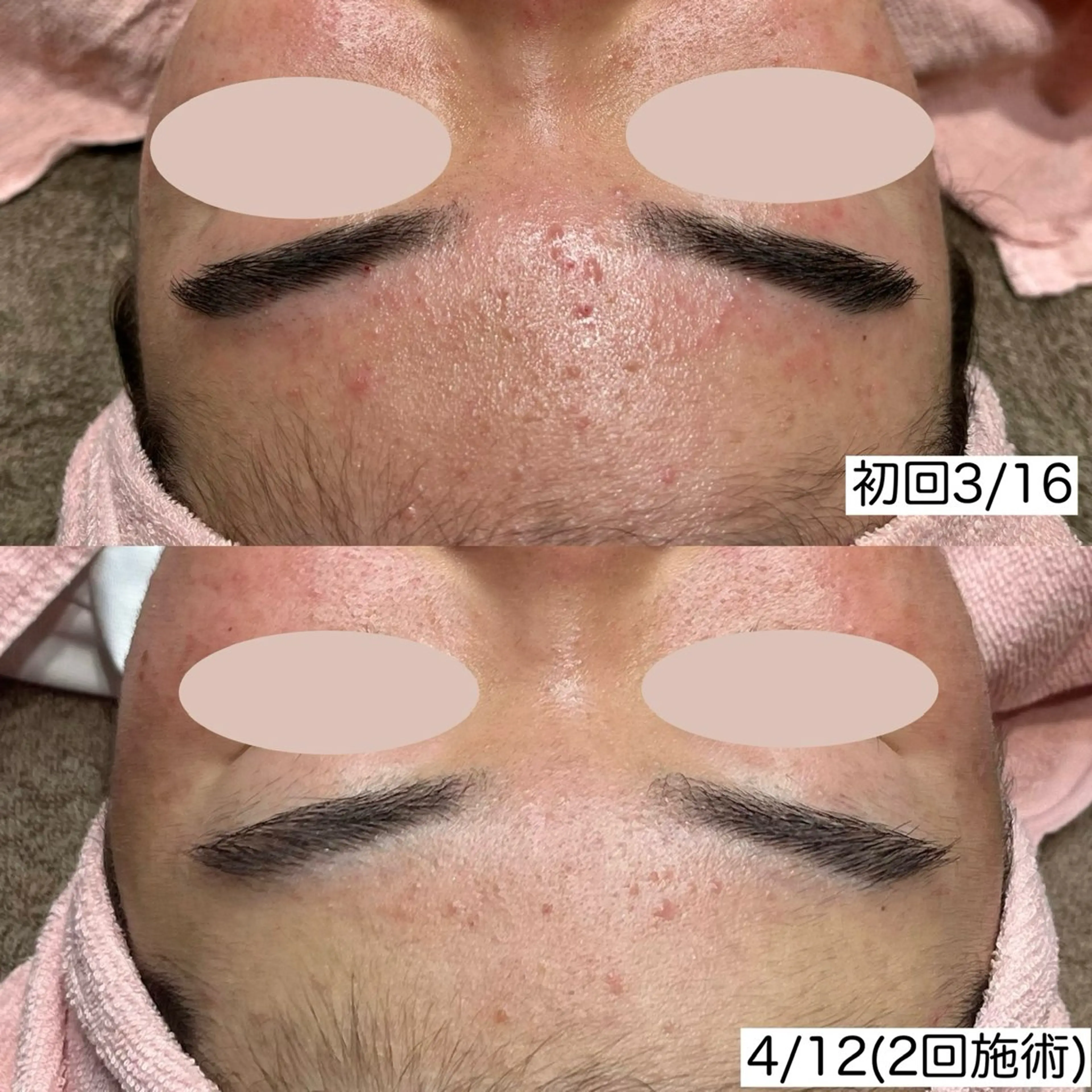 【ニキビ/肌荒れ】プラズマシャワー➕毛穴洗浄(鼻)の写真