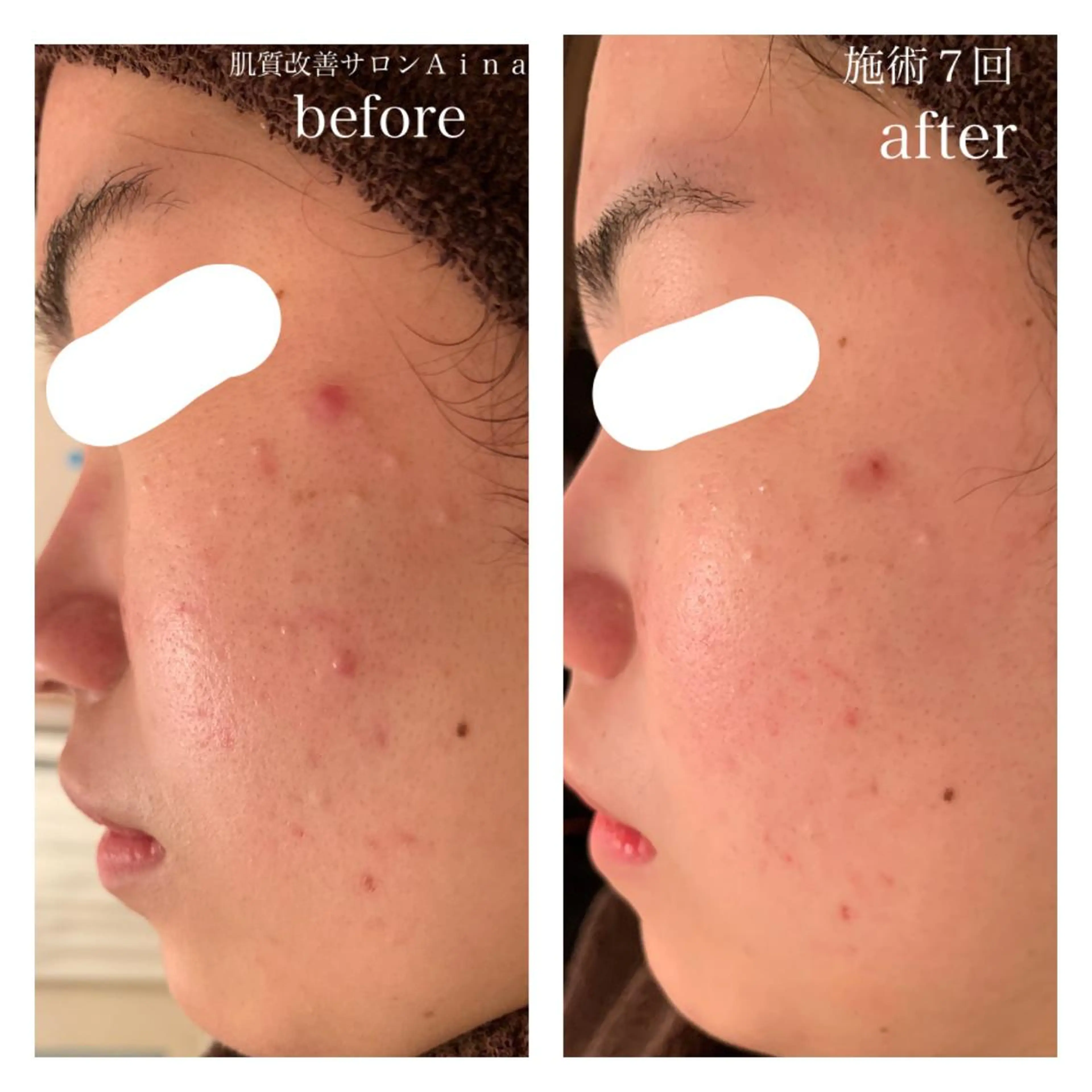 ミディアム パーマ キッズ ネイル マツエク・マツパ エステ リラク ニキビ跡専門サロン Ainaのエステ・リラクイメージ