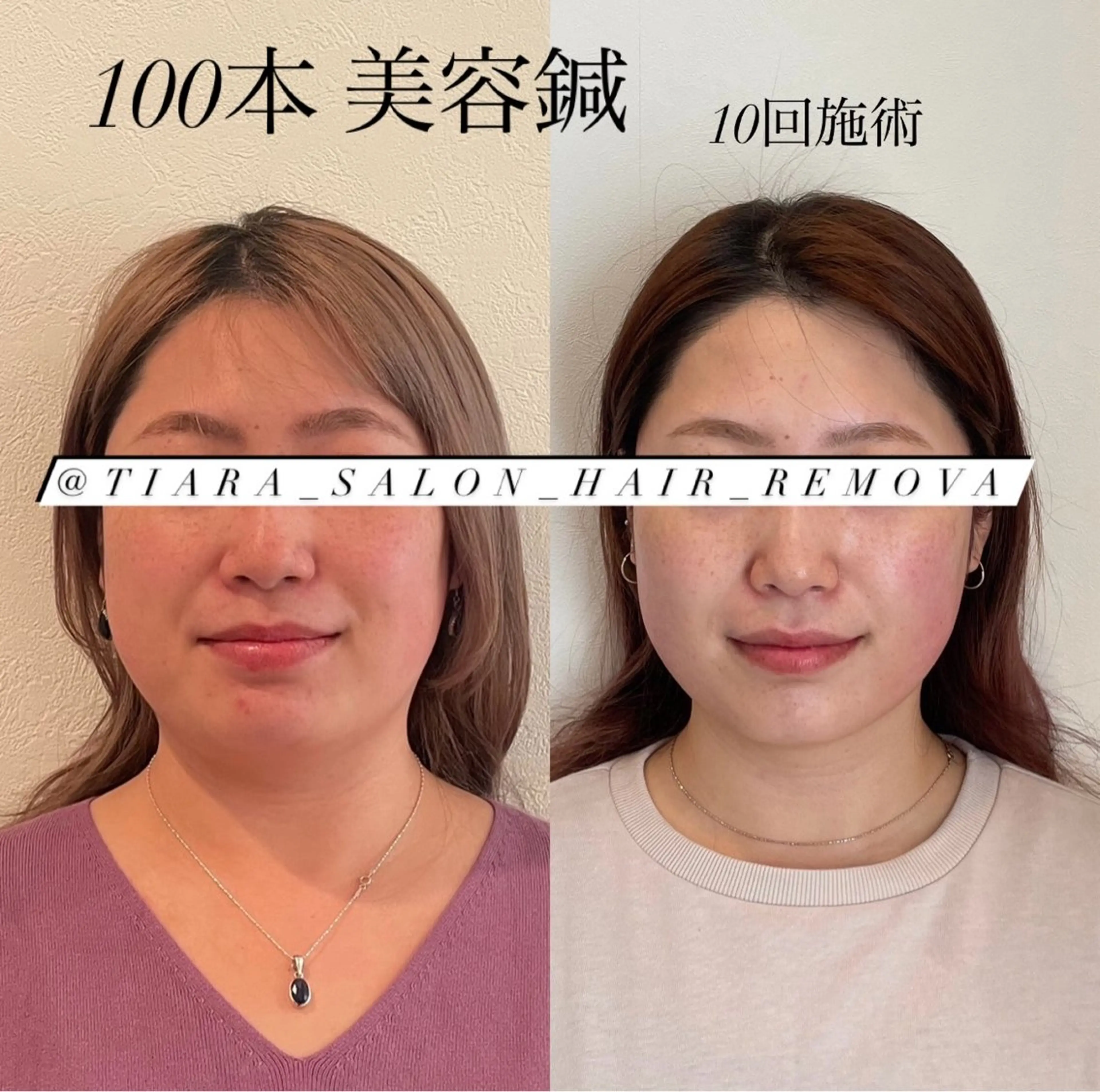 鍼灸サロン TIARA　美容鍼のエステ・リラクイメージ