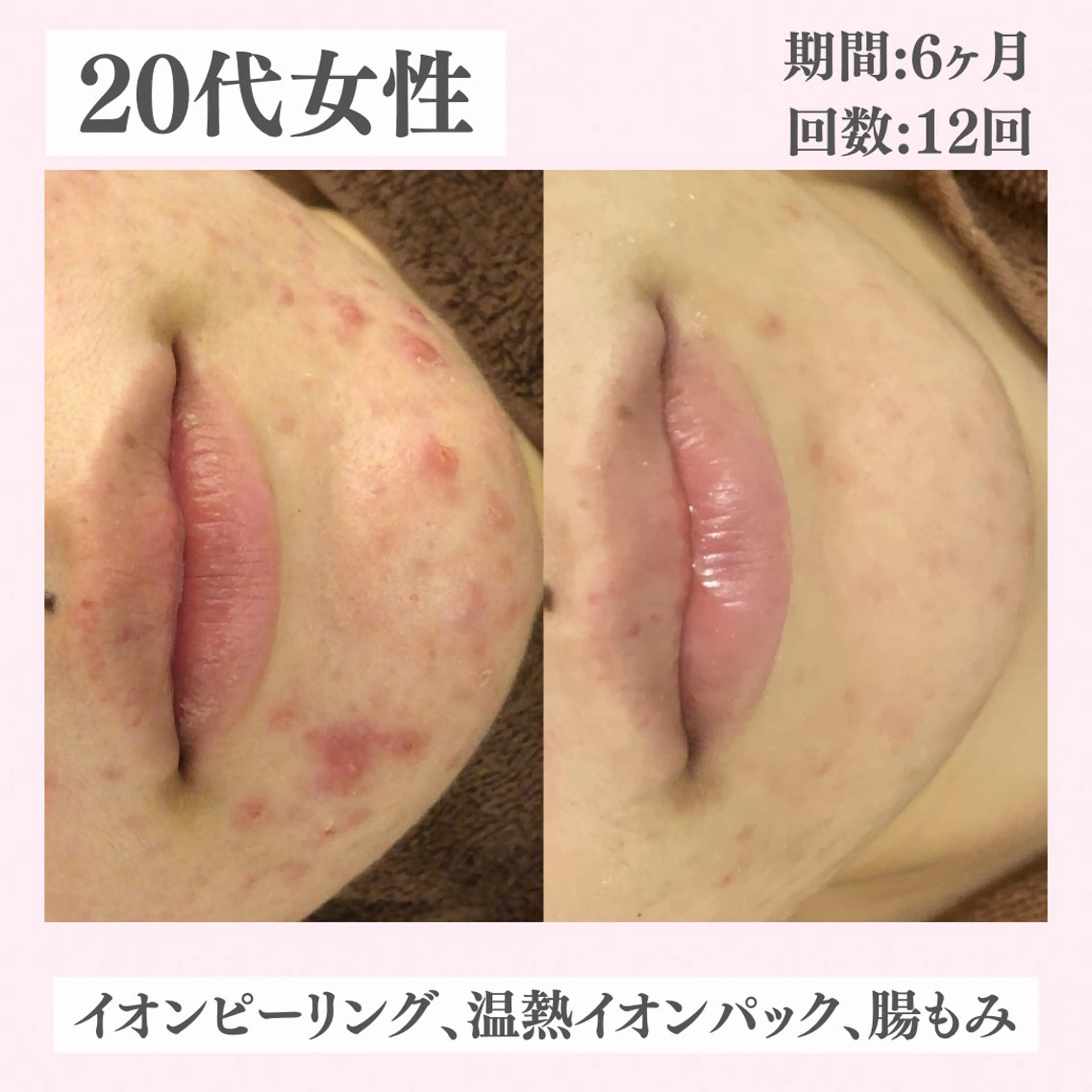 エステ リラク ニキビ・肌質改善専門 ♡人生が変わるサロンのエステ・リラクイメージ