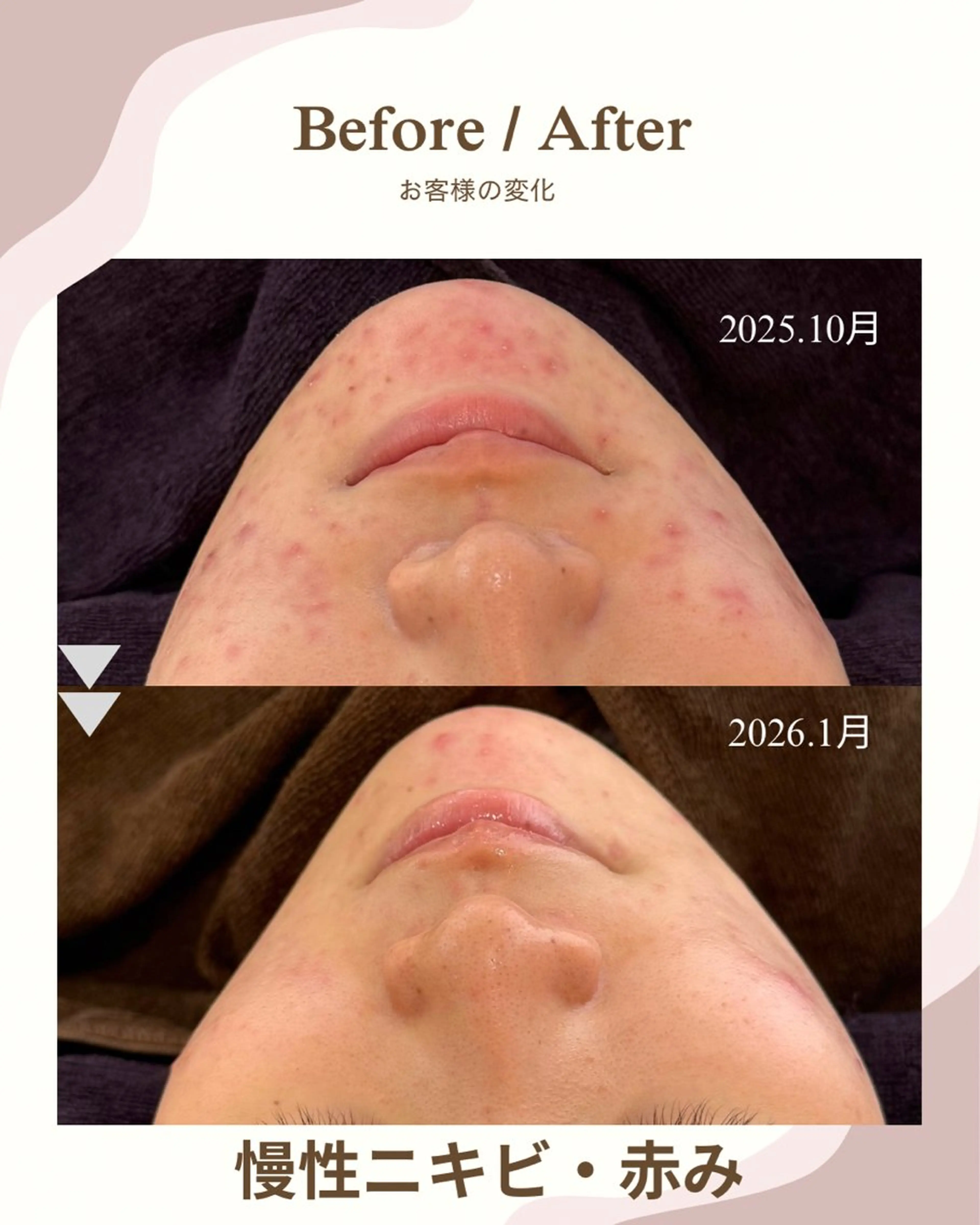 エステ yukiko/美容師 肌質改善/中崎町のエステ・リラクイメージ