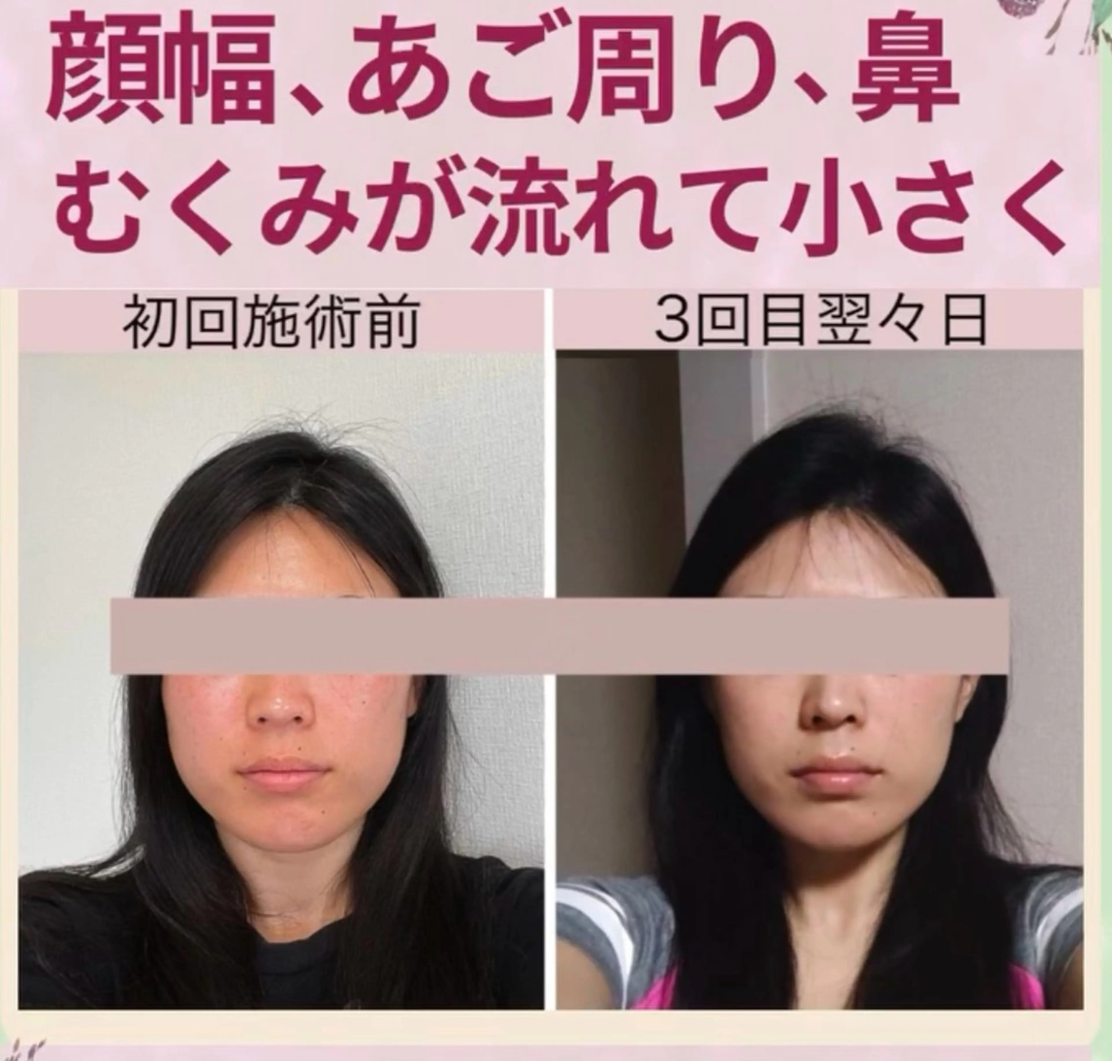 🔰むくみ解消でお顔をひとまわり小さく✨️小顔矯正マッサージ💆‍♀️初回🔰の写真