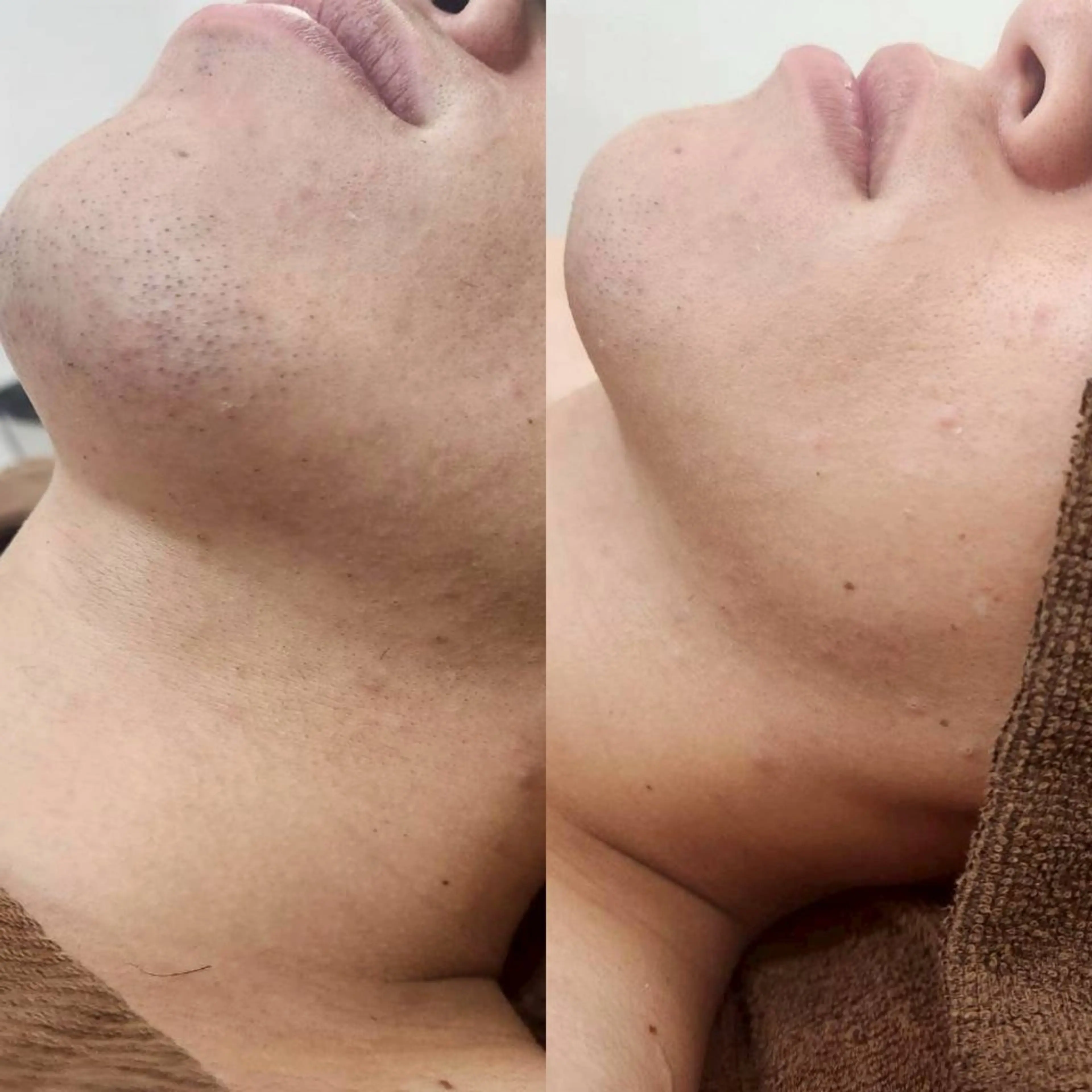 men's ヒゲ脱毛の写真