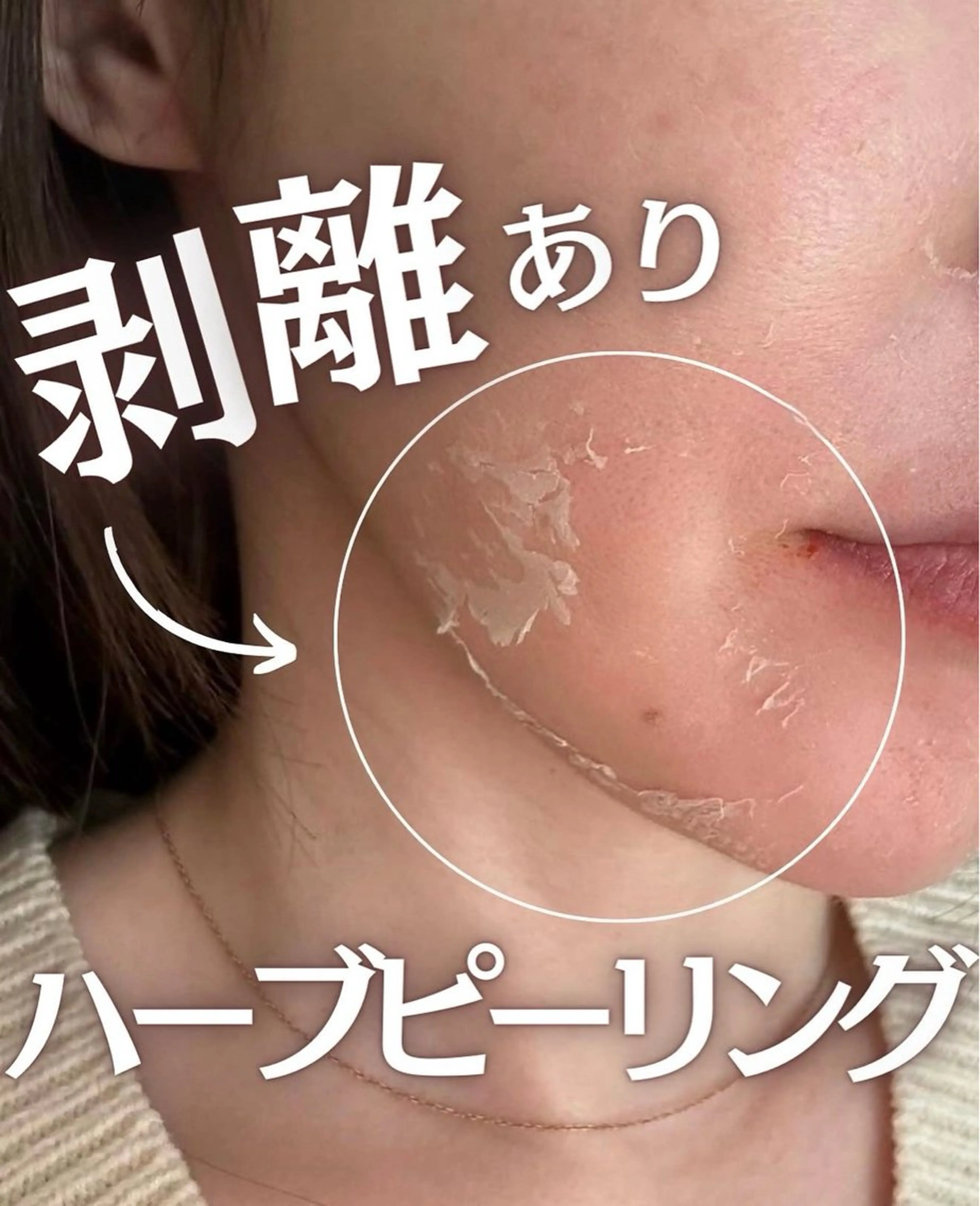 【剥離ありハーブピーリング】💎古い角質をケアして透明感UP🫧の写真