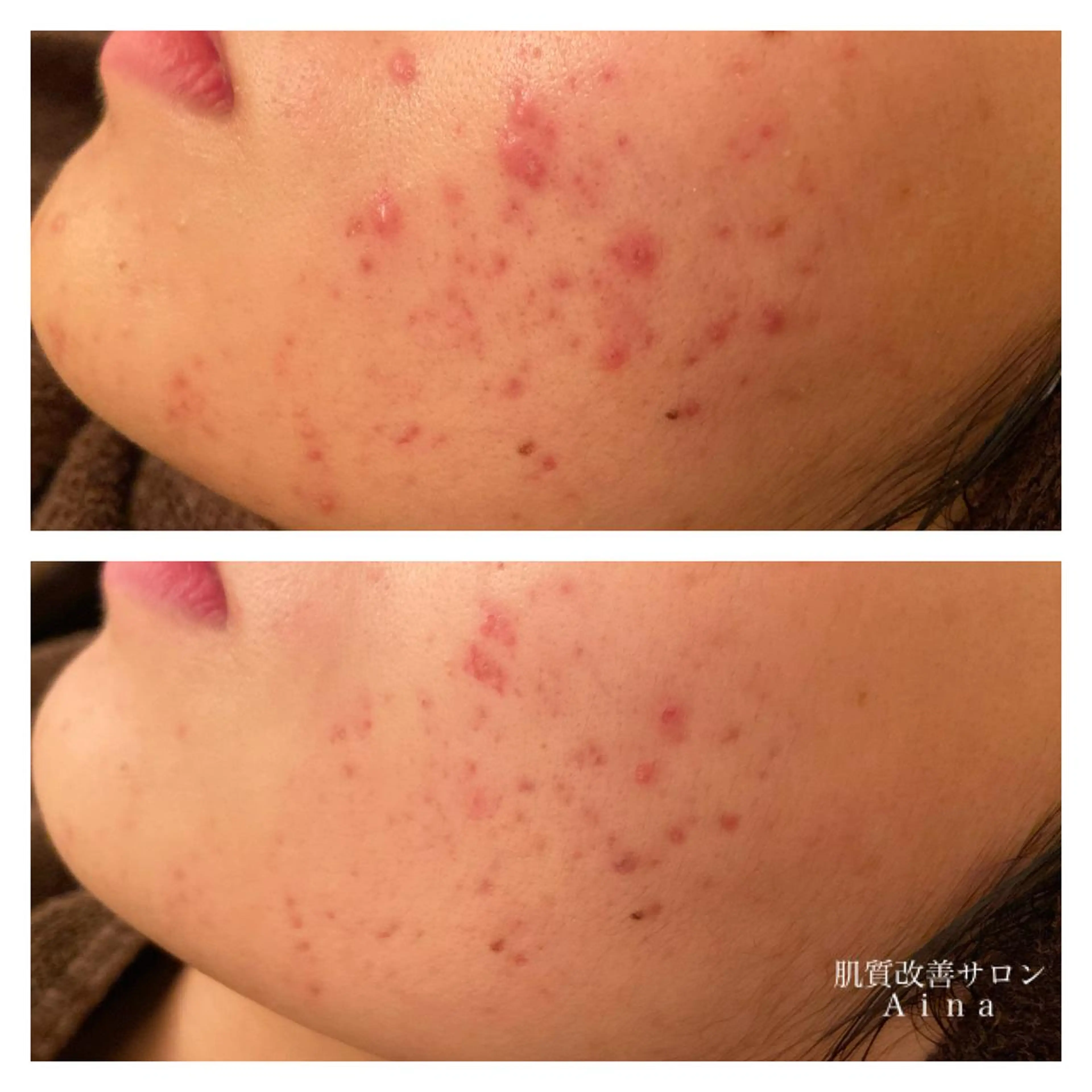 ロング カラー パーマ ヘアアレンジ メンズ キッズ ネイル マツエク・マツパ エステ リラク ニキビ跡専門サロン Ａｉｎａのエステ・リラクイメージ