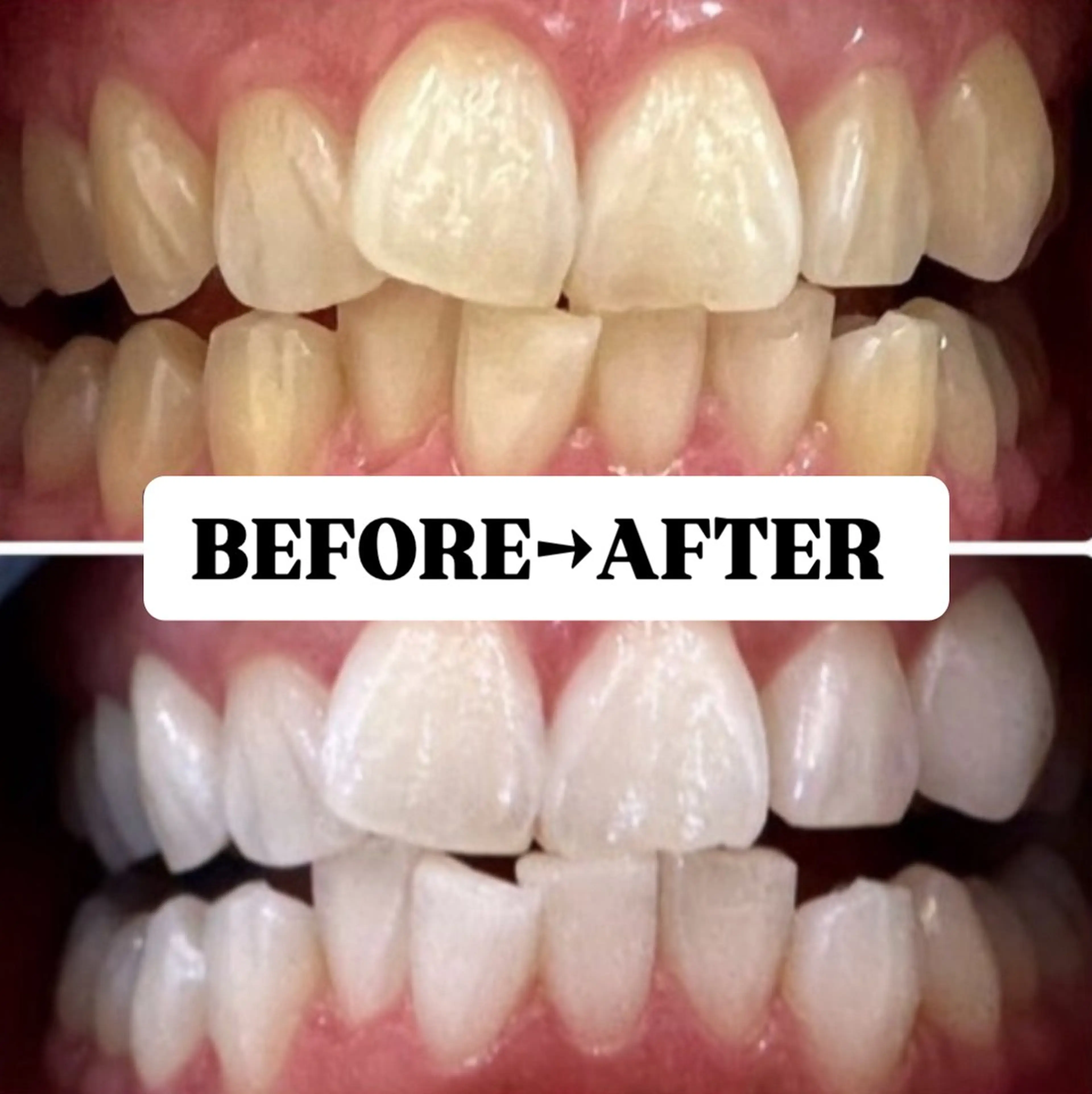 【2回目以降都度払い♪】美白ホワイトニング 20分×2回 ¥7980の写真