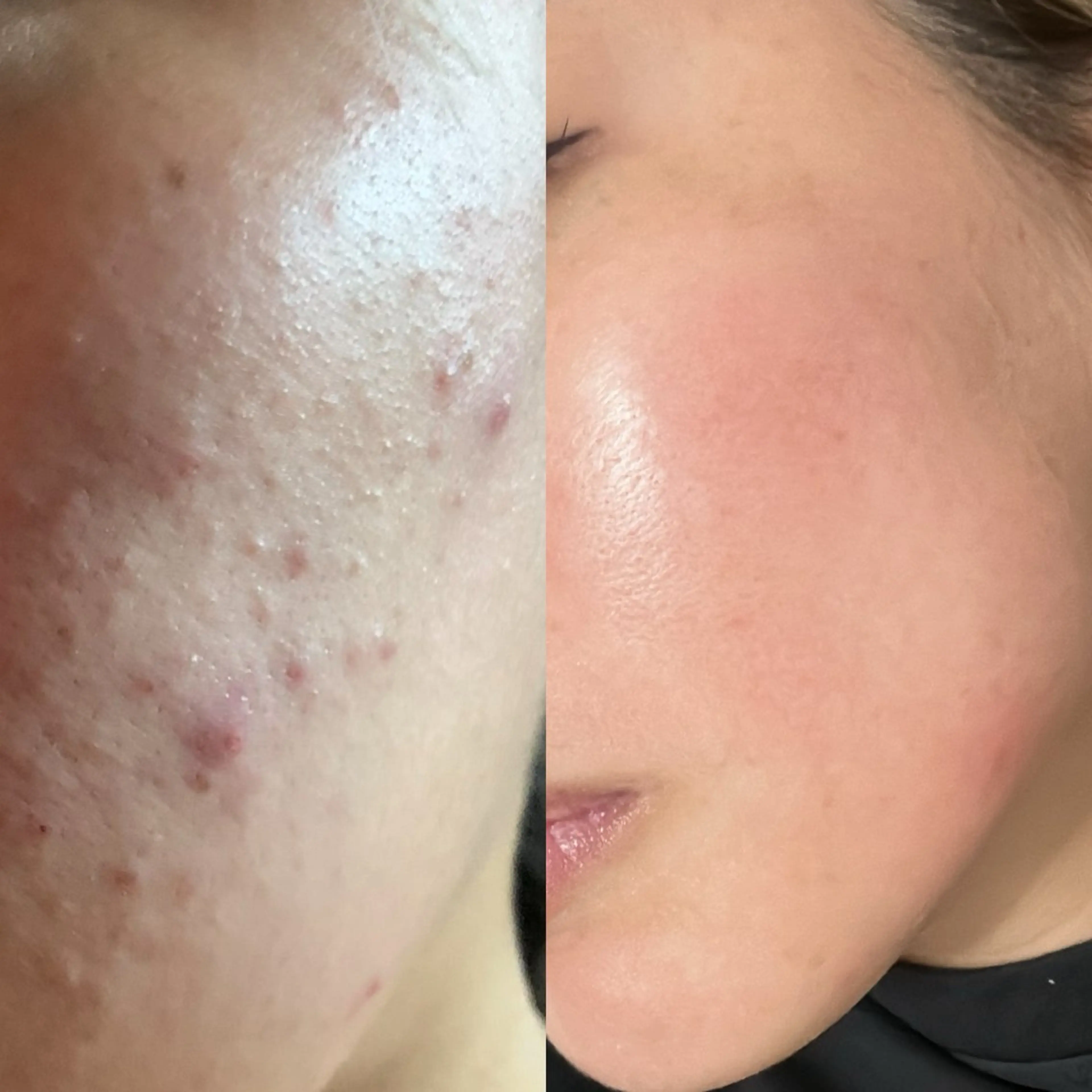 ✨毛穴洗浄無料！✨ニキビ・ニキビケア改善！韓国剥離ハーブピーリング🇰🇷の写真