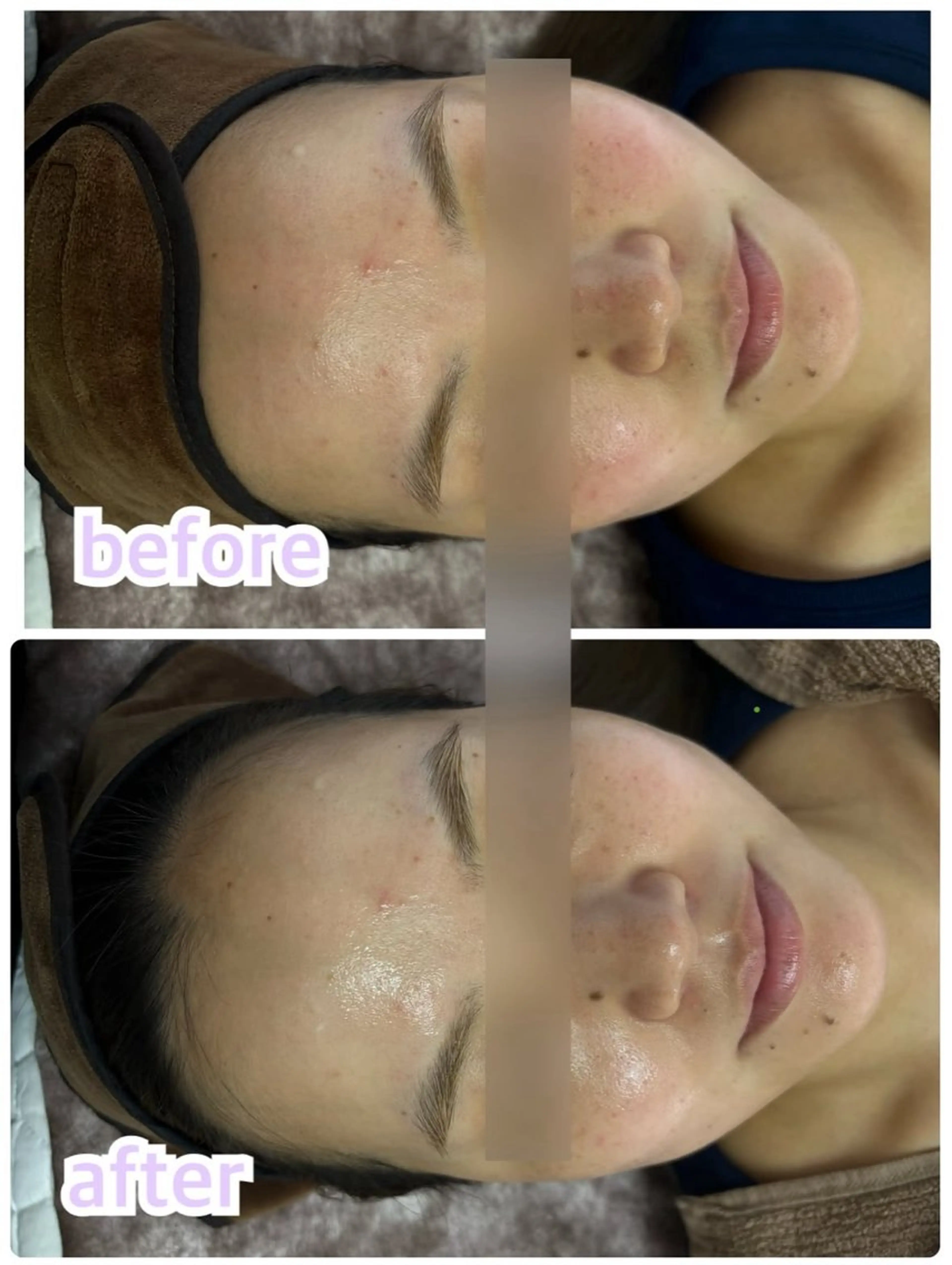 エステ 美肌・小顔専門🪄 看護師施術/松﨑のエステ・リラクイメージ