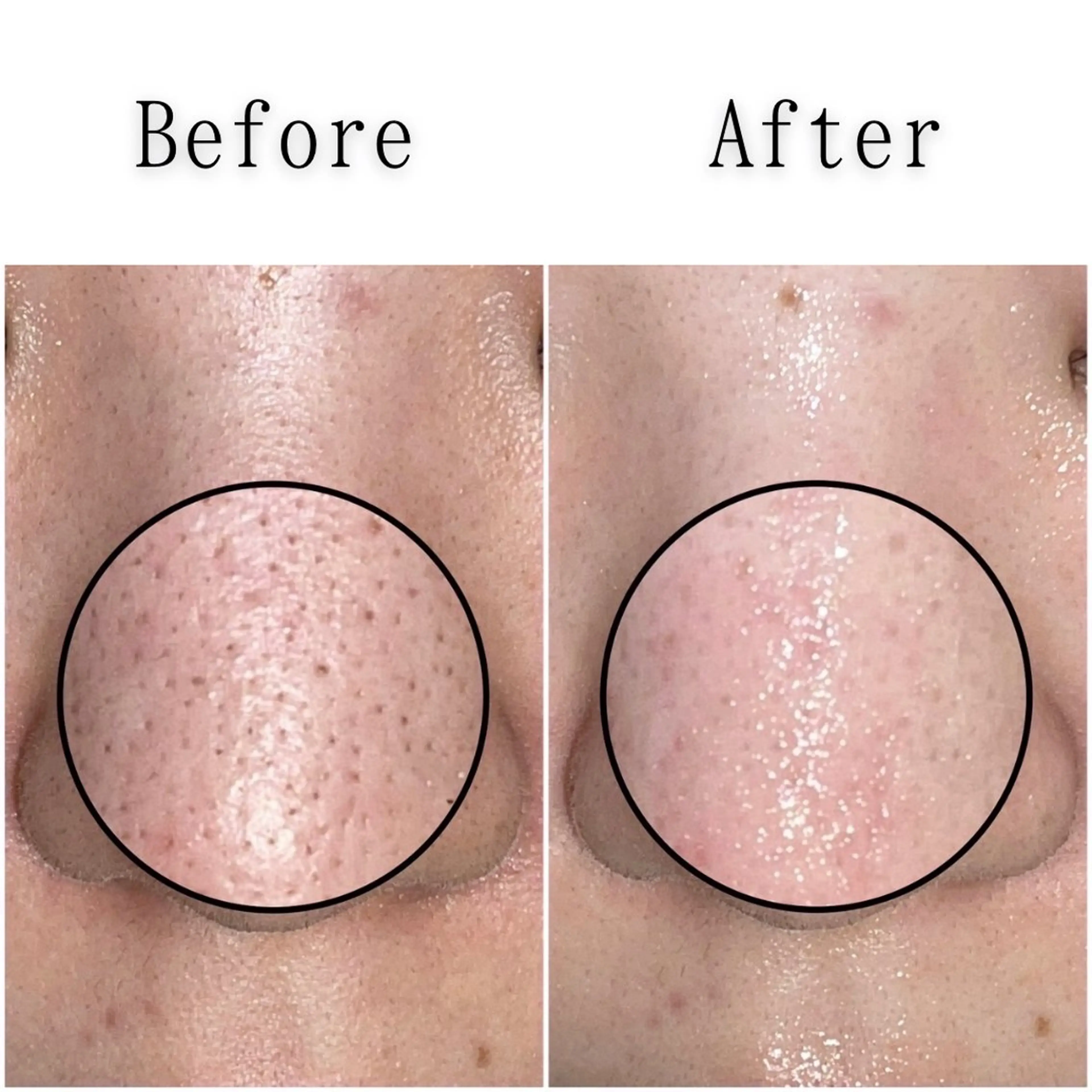 【鼻専用毛穴吸引】の写真