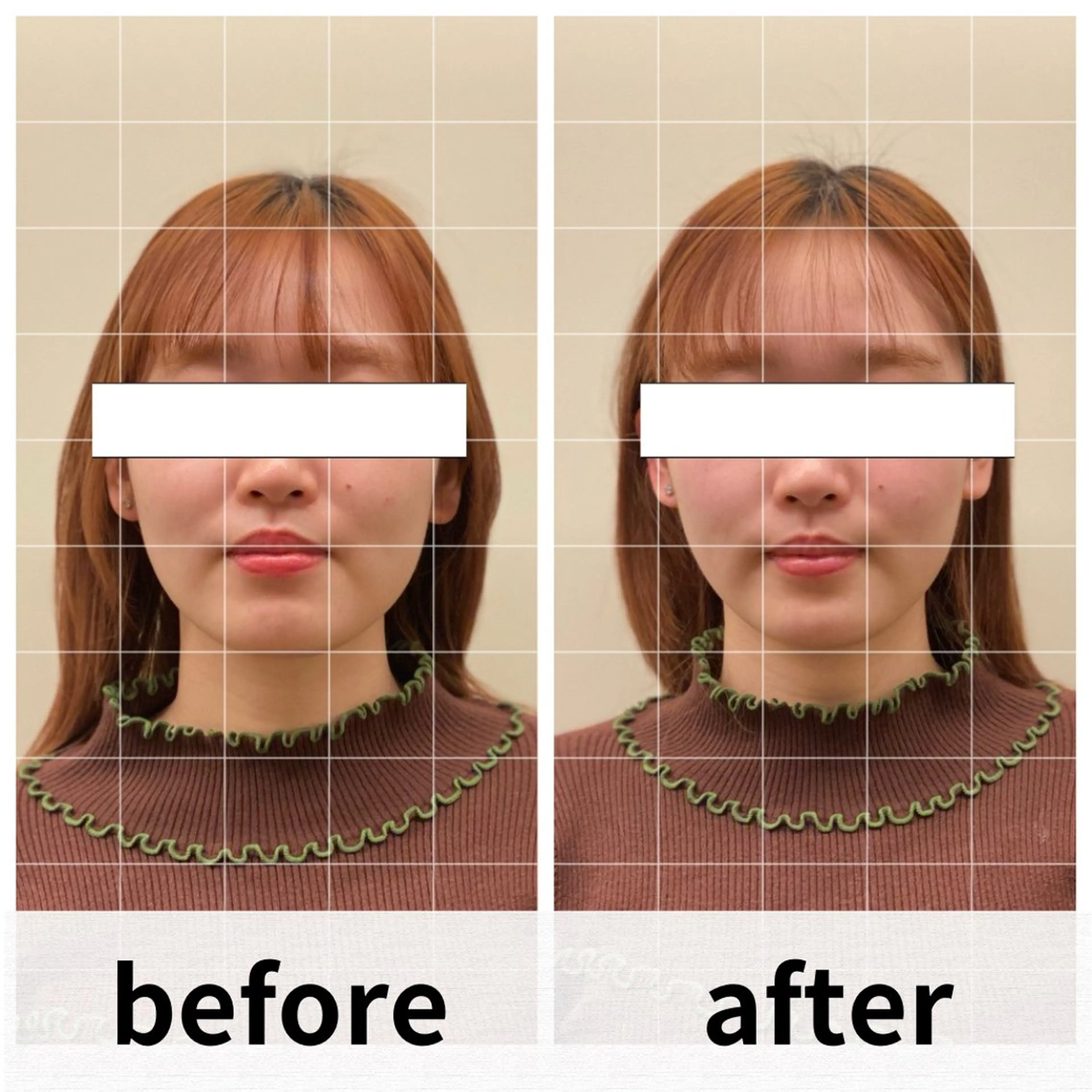 【小顔・リフトアップ エラ張りにお悩みの方へ】美容鍼×フェイシャルエステによるスペシャルケア🦋🦋🦋の写真