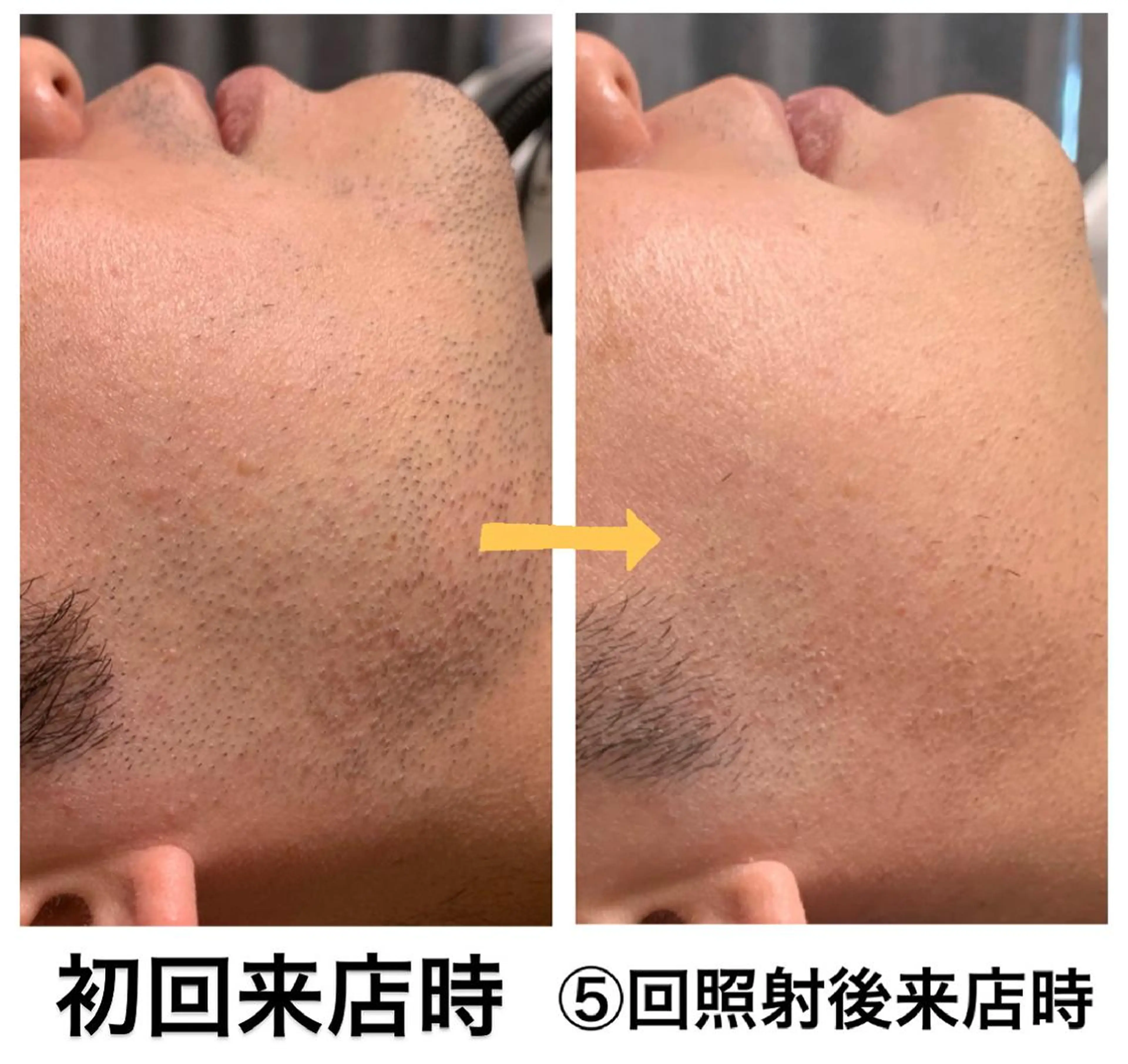 脱毛 メンズ脱毛サロン Le falcoのエステ・リラクイメージ