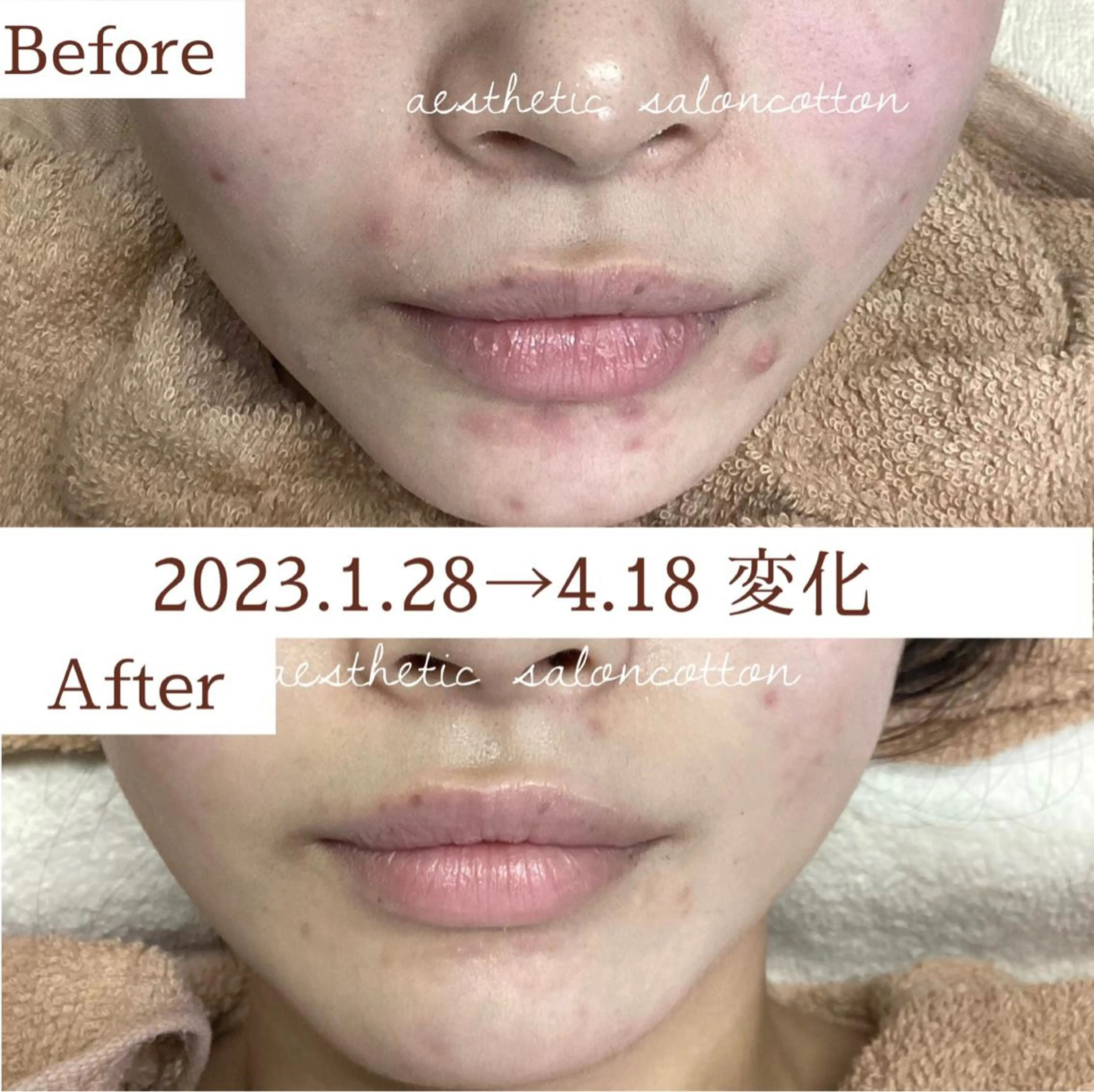 エステ 都度払い 肌質改善専門サロンのエステ・リラクイメージ