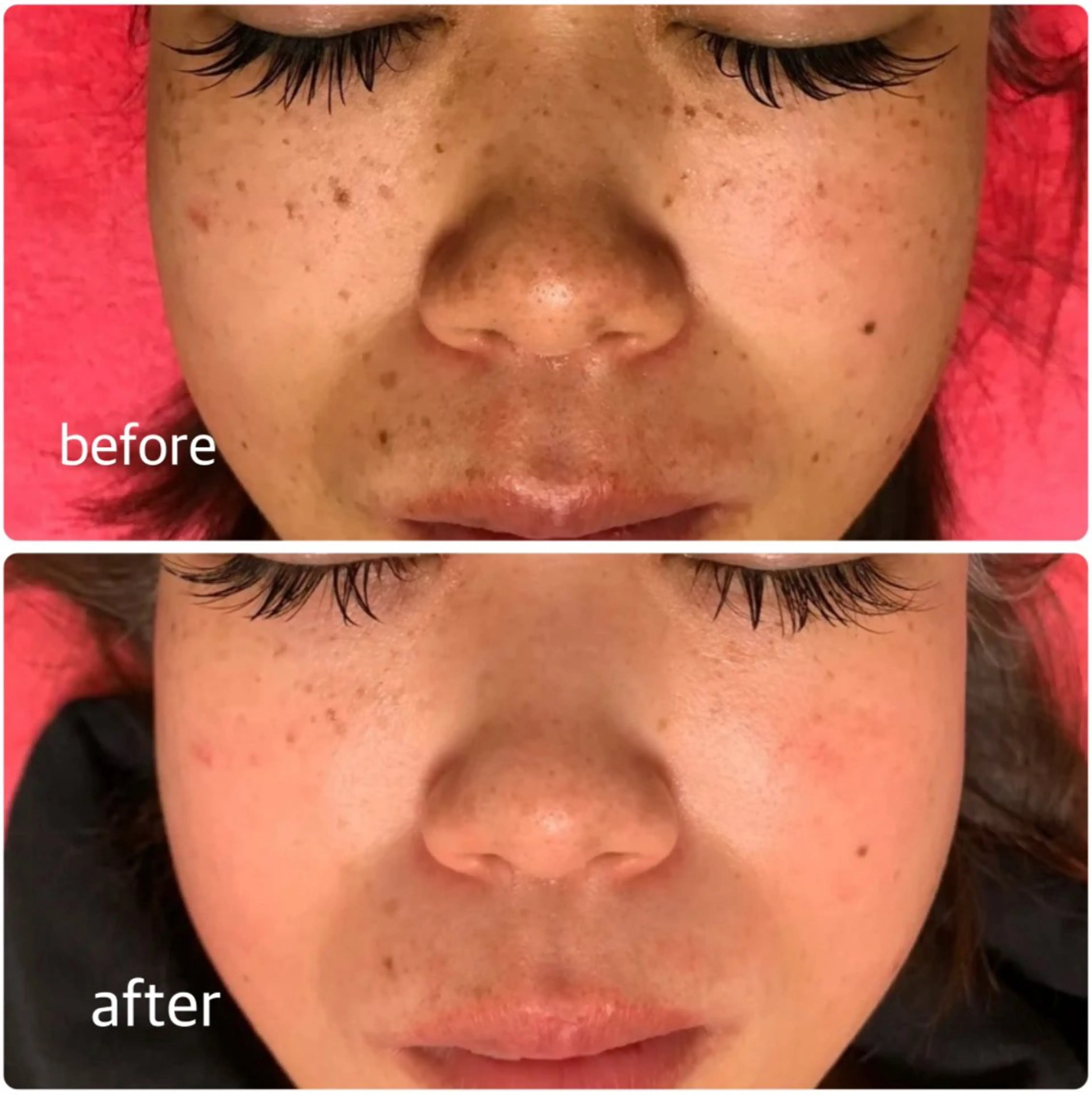 【毛穴レス美肌】美肌フェイシャル　3,400円→2,500円の写真