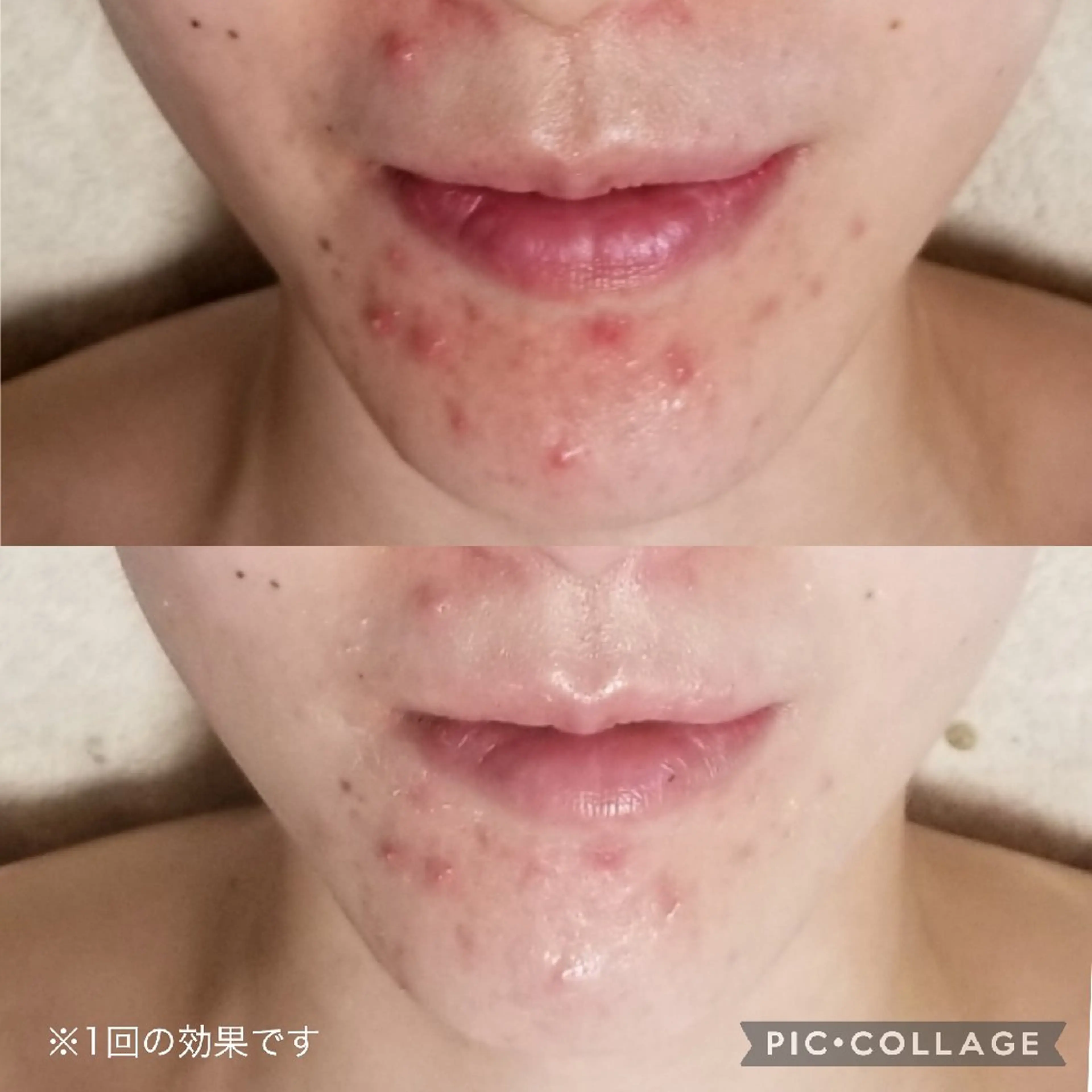 エステ 毛穴フェイシャルエステkokotto板橋所属・【毛穴ハーブピーリン グ】板橋1位のエステ・リラクイメージ