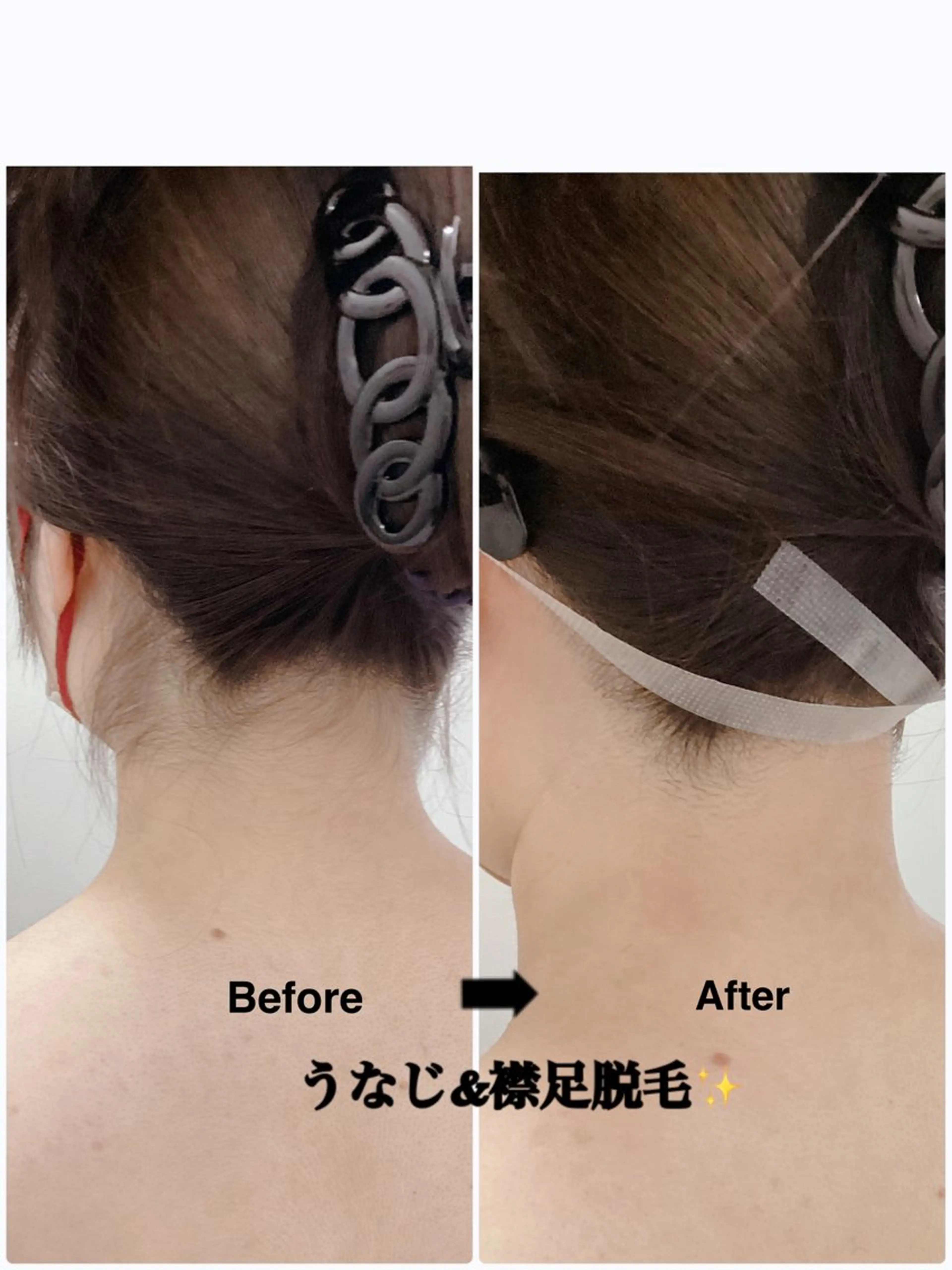 👱‍♀️うなじ&襟足脱毛👱‍♀️ ミニモ学割❗️30分平日学生限定🈹¥2,800→¥1,500の写真