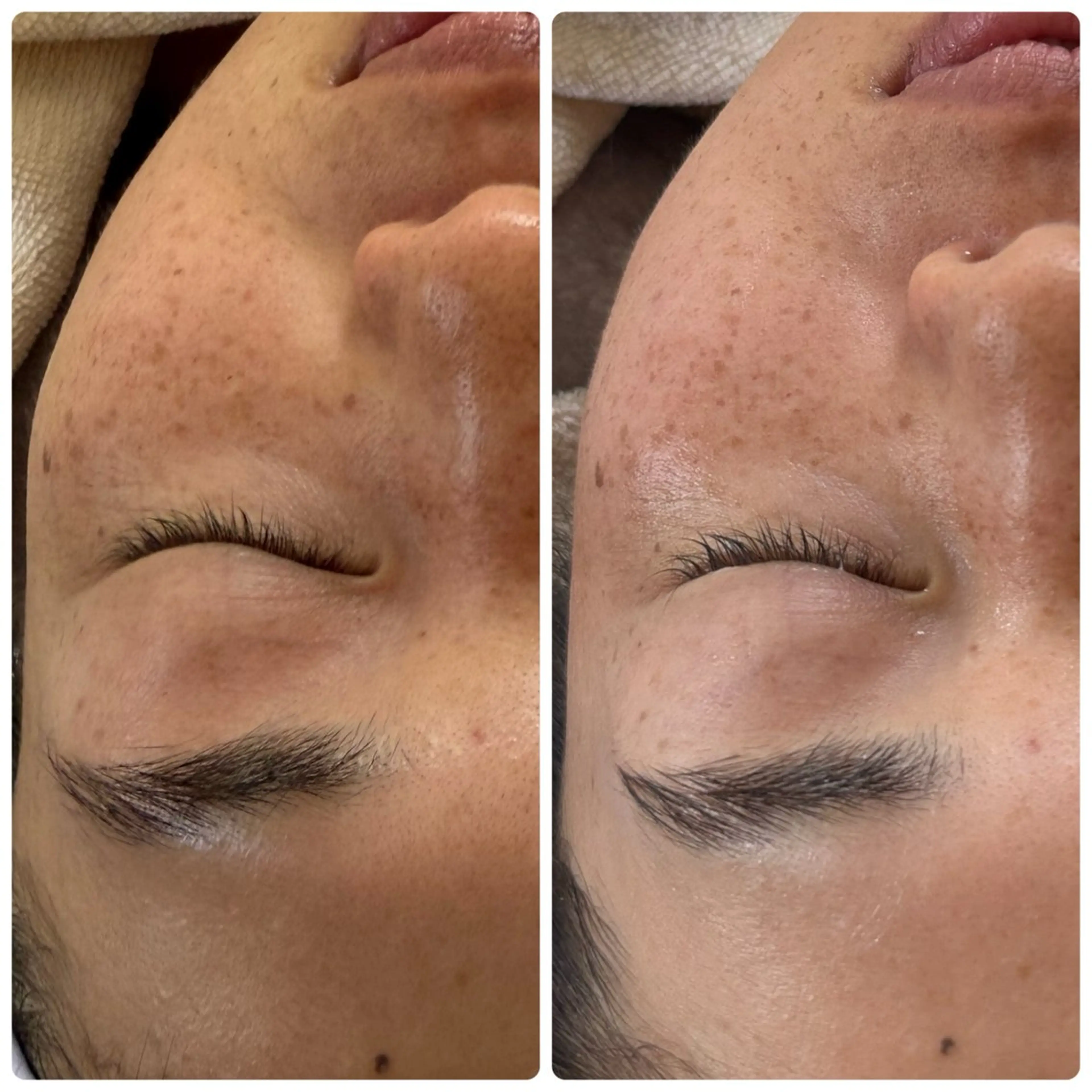 〈お顔の不要なものを取り除き、ワントーン明るい肌へ〉フェイシャルワックスの写真