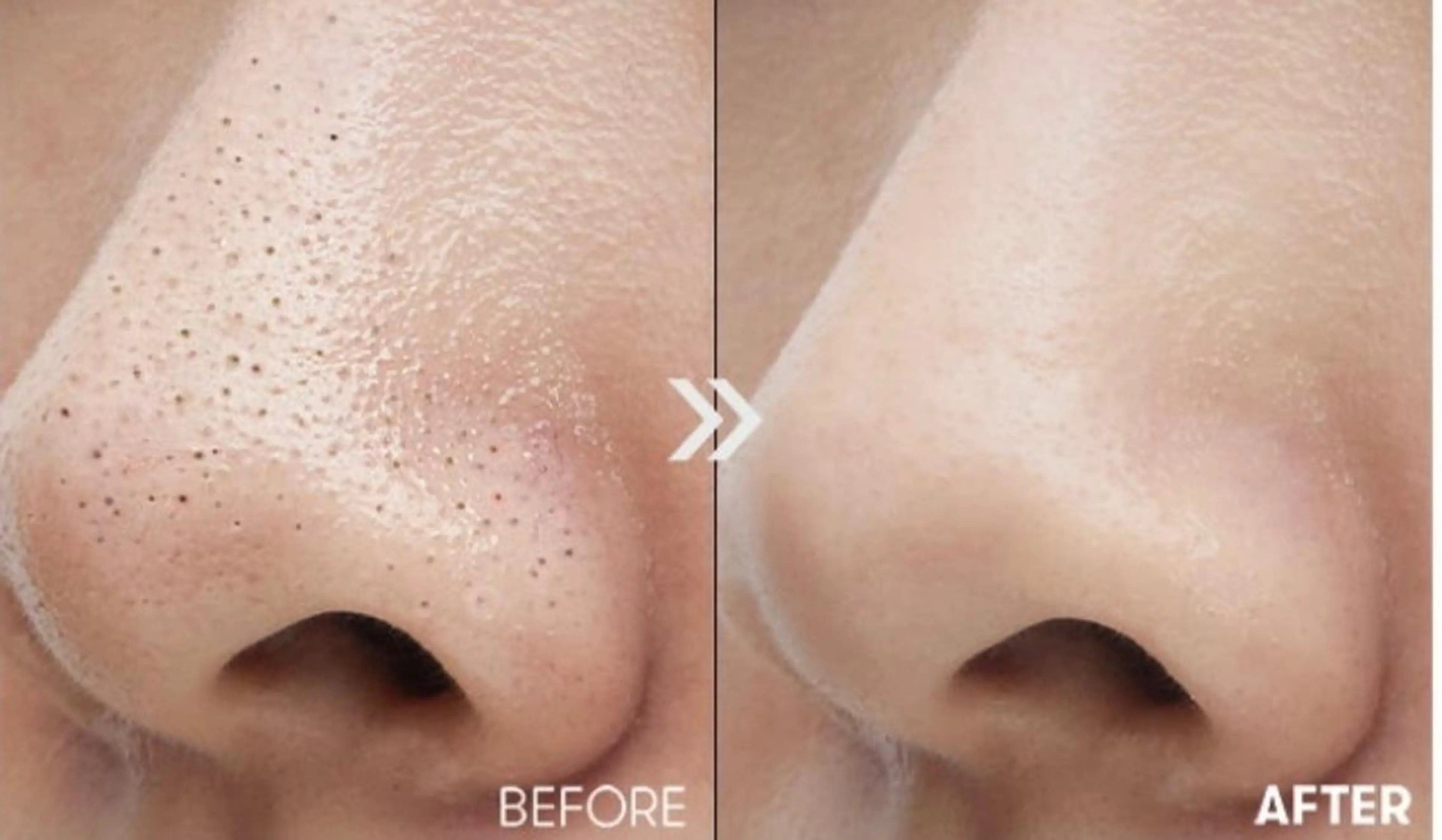 大人気‼️\憧れの“毛穴レス肌”へ✨/角栓やゴワつきをやさしくケア✨固くなったお肌をほぐして、プルンッとした陶器肌へ導くの写真