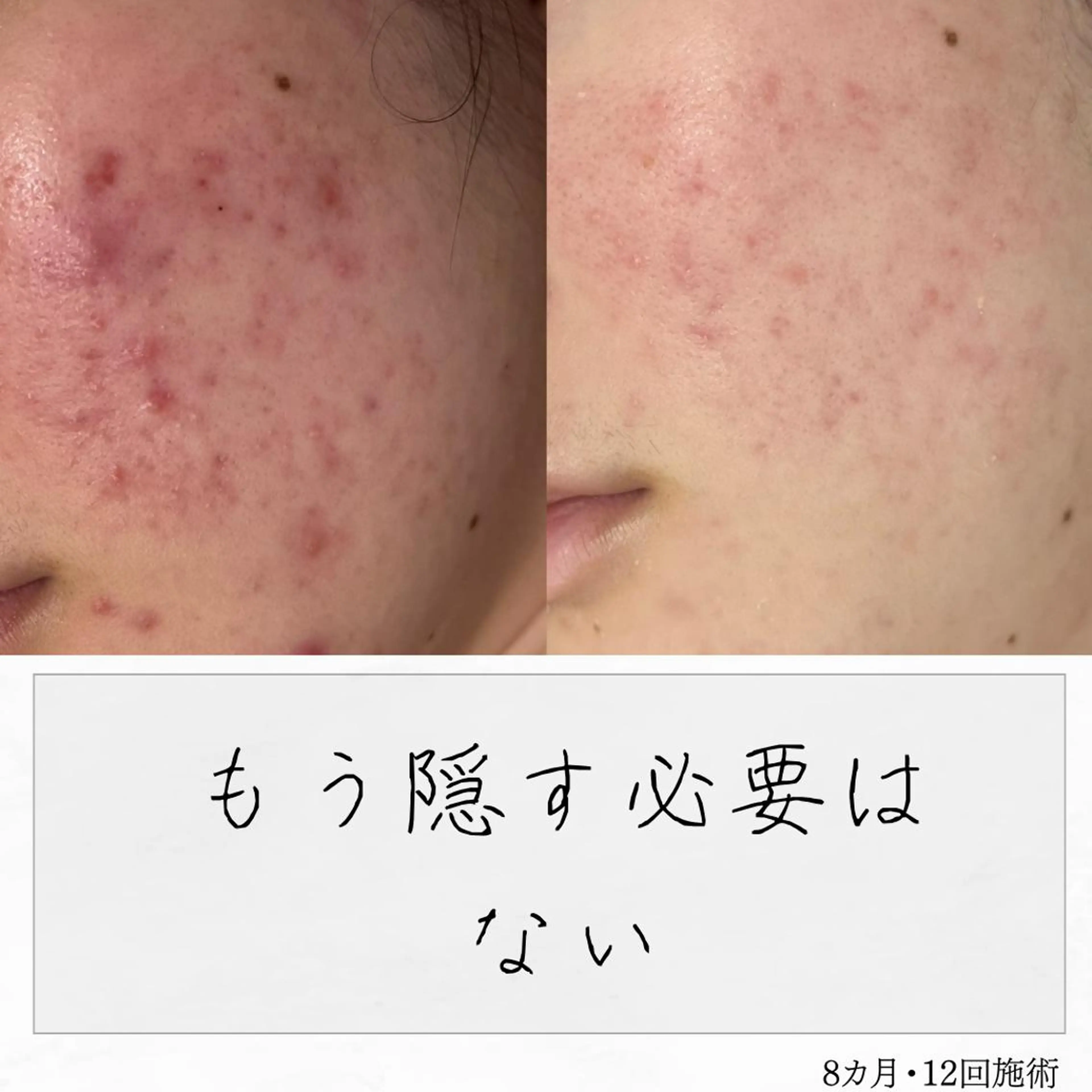 ニキビ経験者が施術 する専門サロン🌻のエステ・リラクイメージ