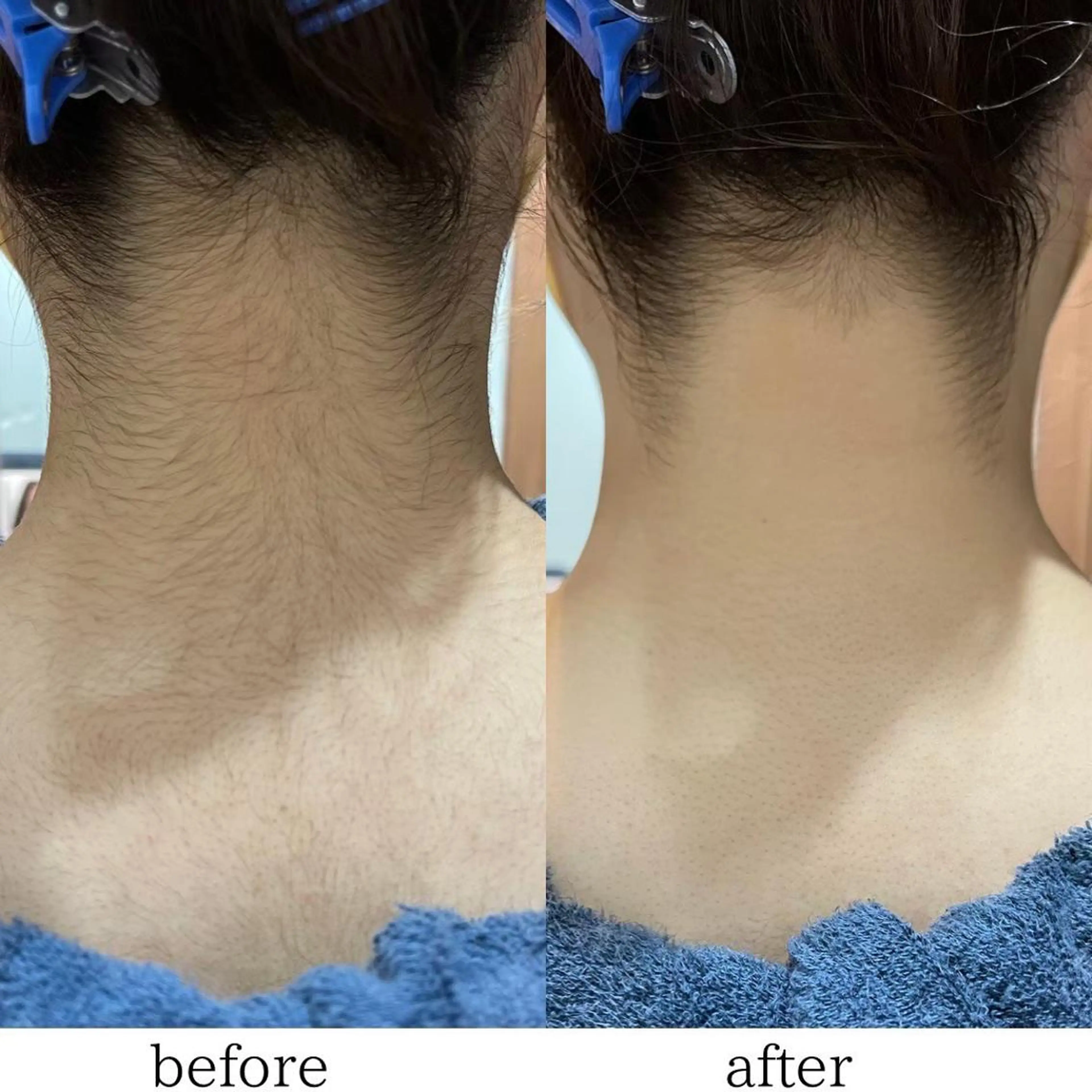 当日予約＆16時まで限定クーポン✨　お顔＋拭き取りパックの大人気組み合わせ❣️の写真