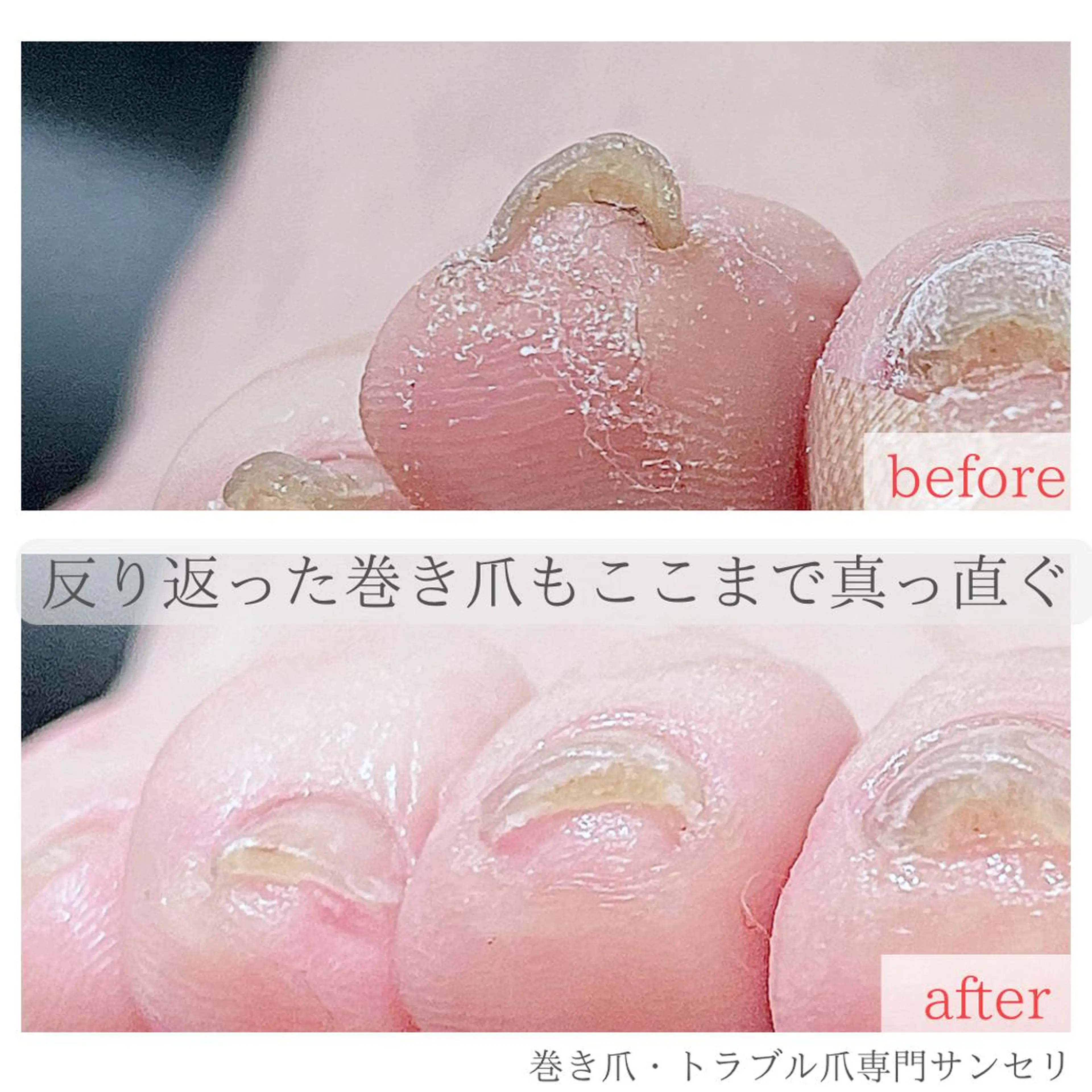 ネイル 深爪・巻き爪 専門サンセリテのネイルデザイン