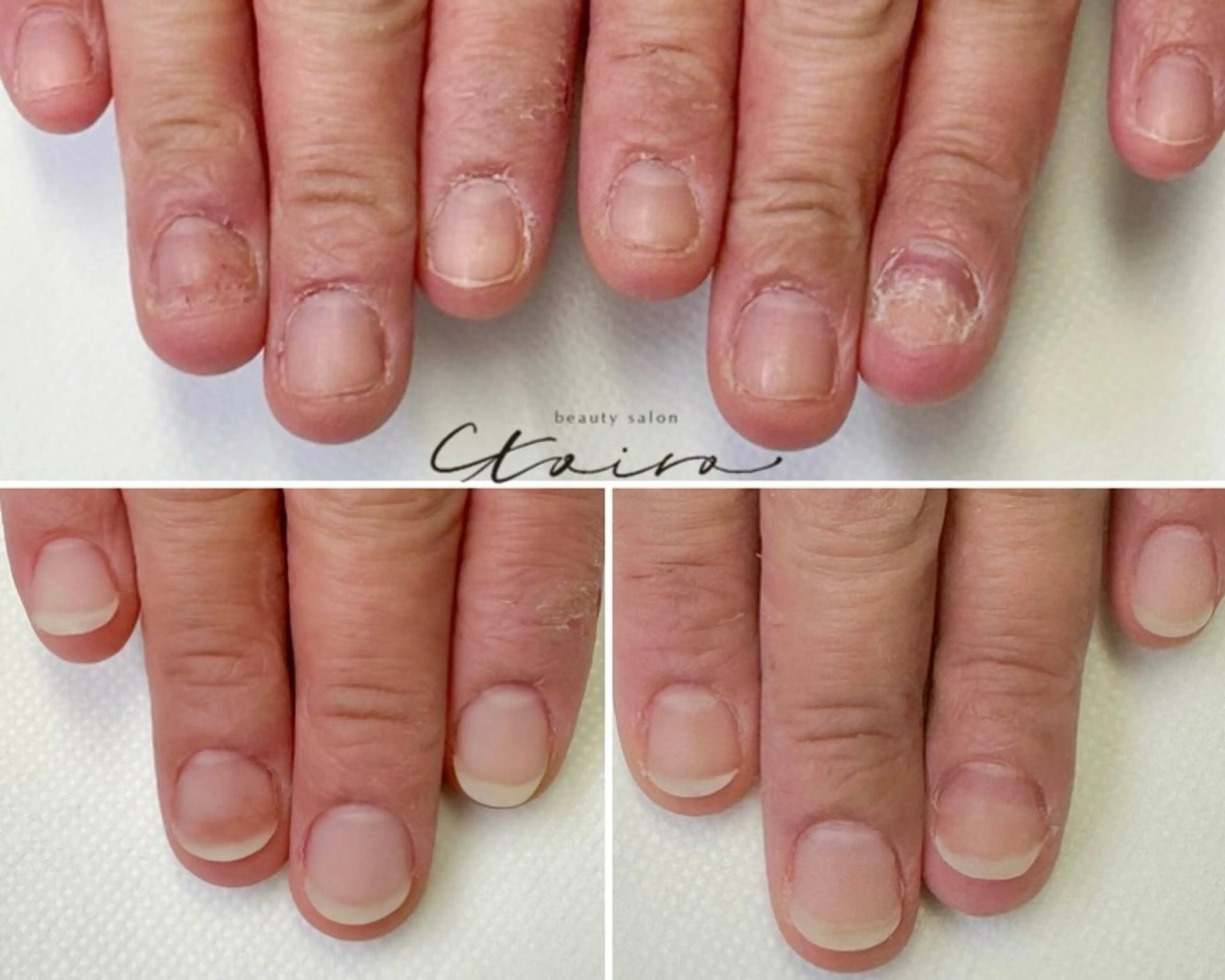 メンズ ネイル フットネイル 深爪矯正専門店　ネイルサロン　トイロ所属・ネイルサロン トイロのネイルデザイン