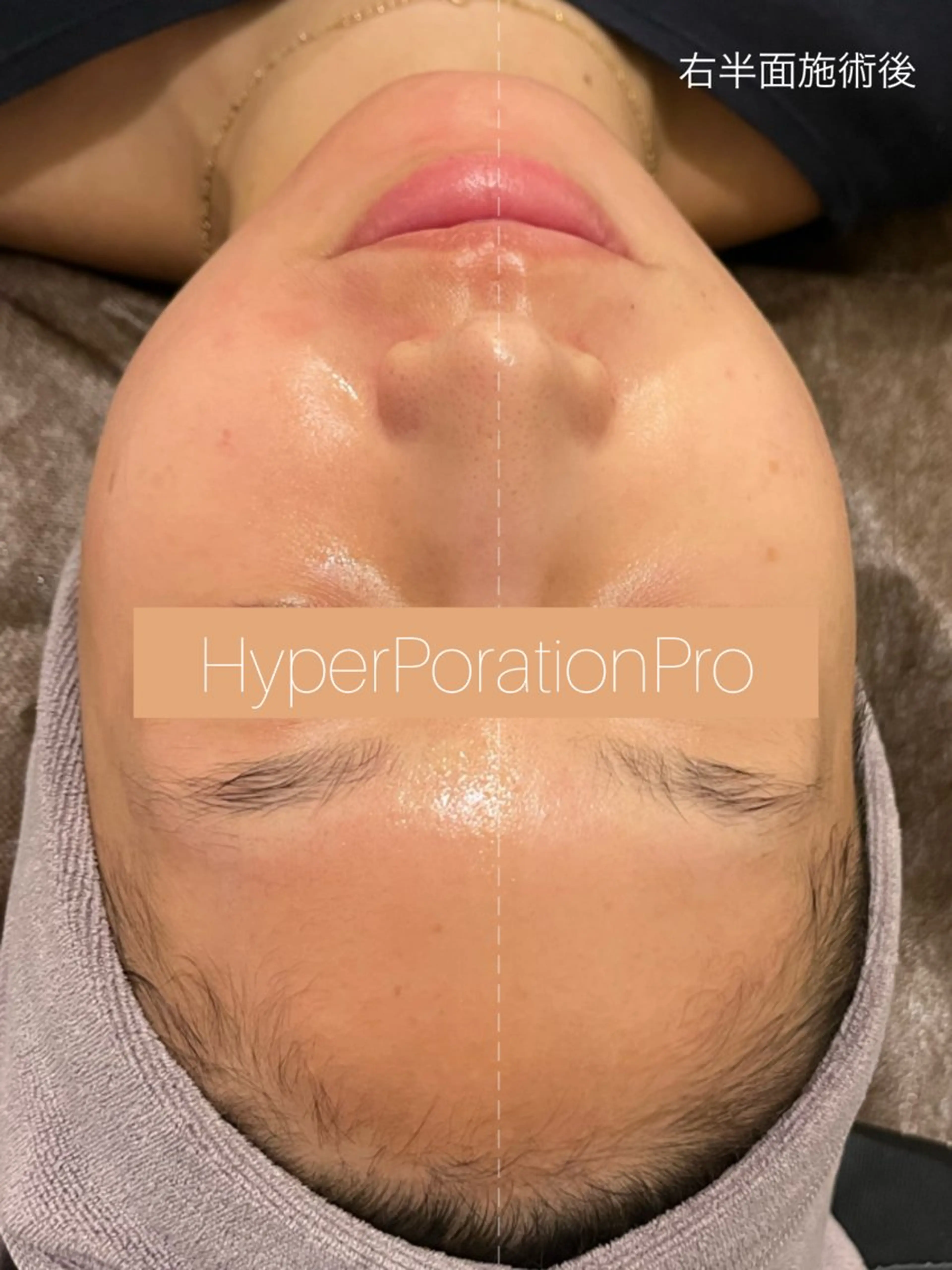 🍎リンゴ🍏【イオン20倍の浸透力♪】で、お肌が見違えます😳エレクトロポレーション✨✨の写真