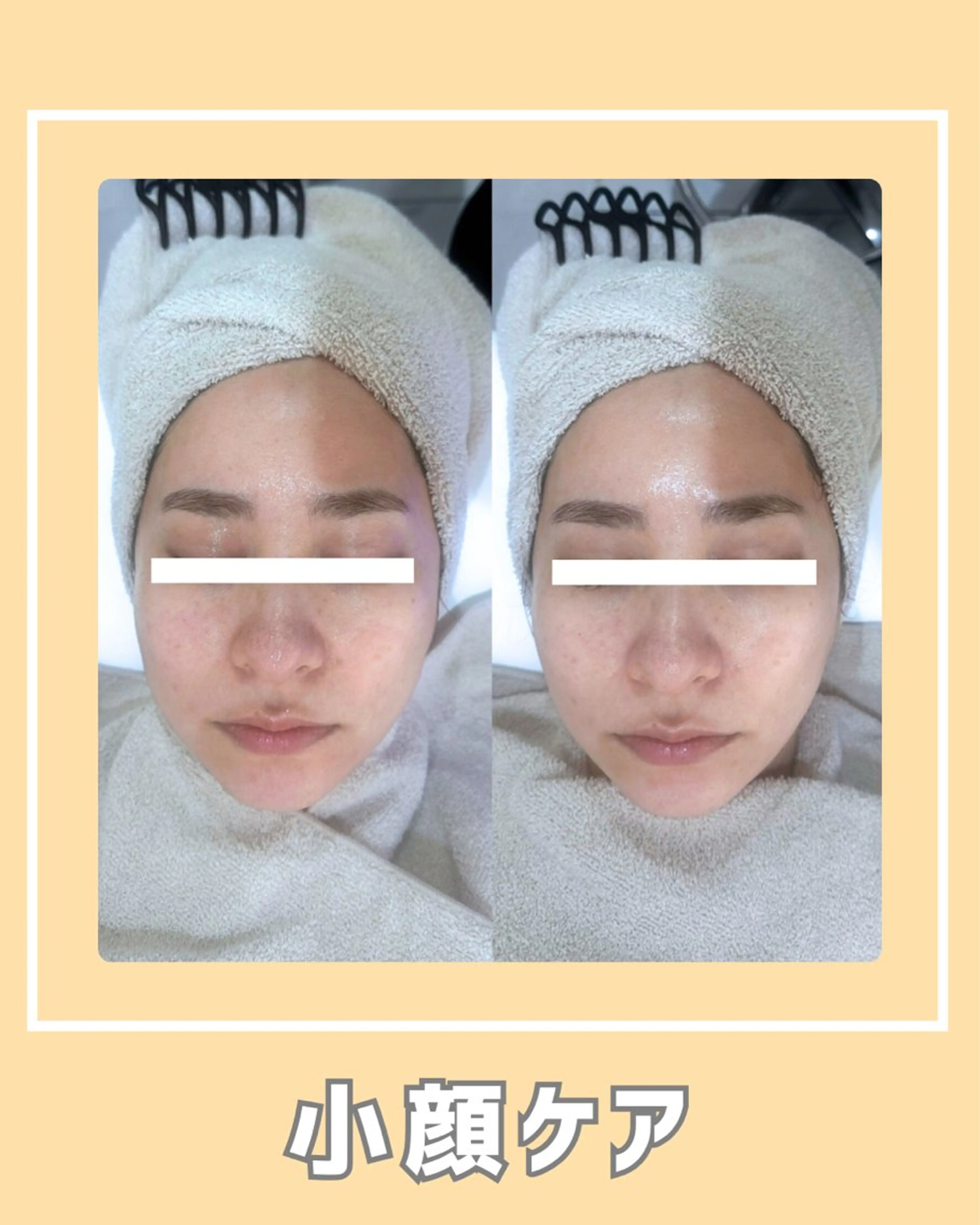 その他 |ピーリング・毛穴| soina神楽坂のエステ・リラクイメージ