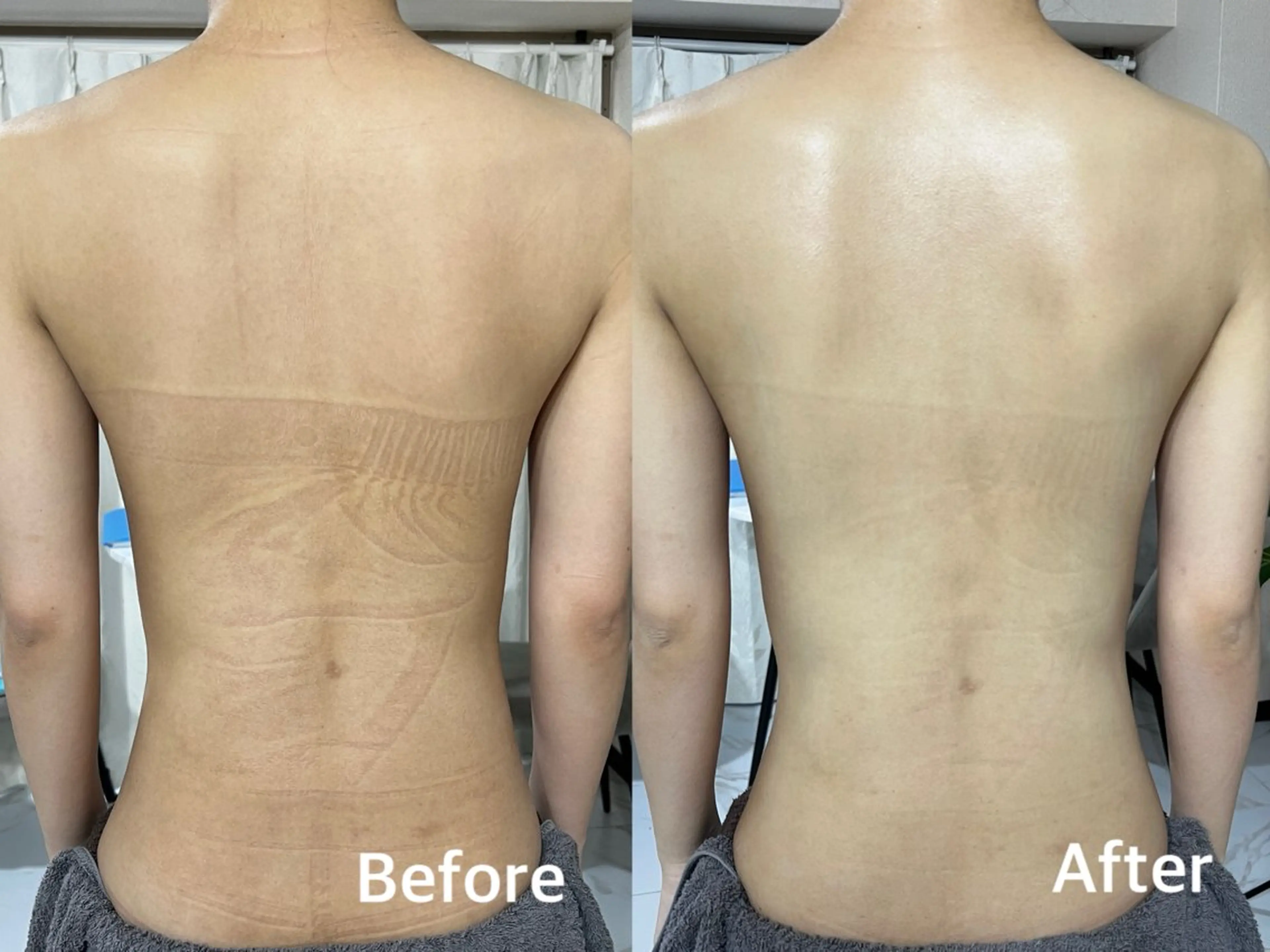 【背中全体｜ざらつき・肌荒れケア】 REVIハーブピーリング🌿陶肌トリートメントの写真