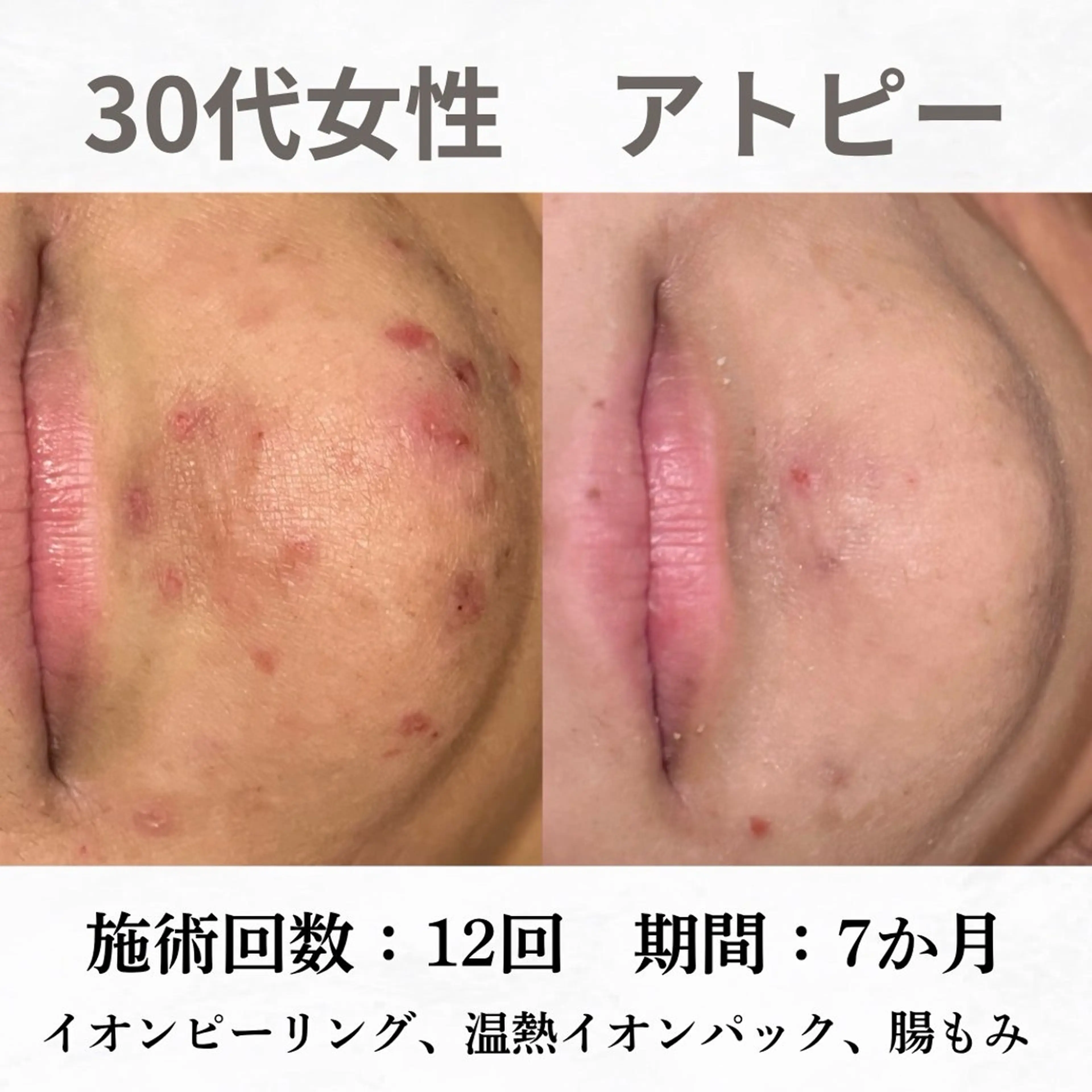 重度ニキビ専門🌷 ダウンタイムなしのエステ・リラクイメージ