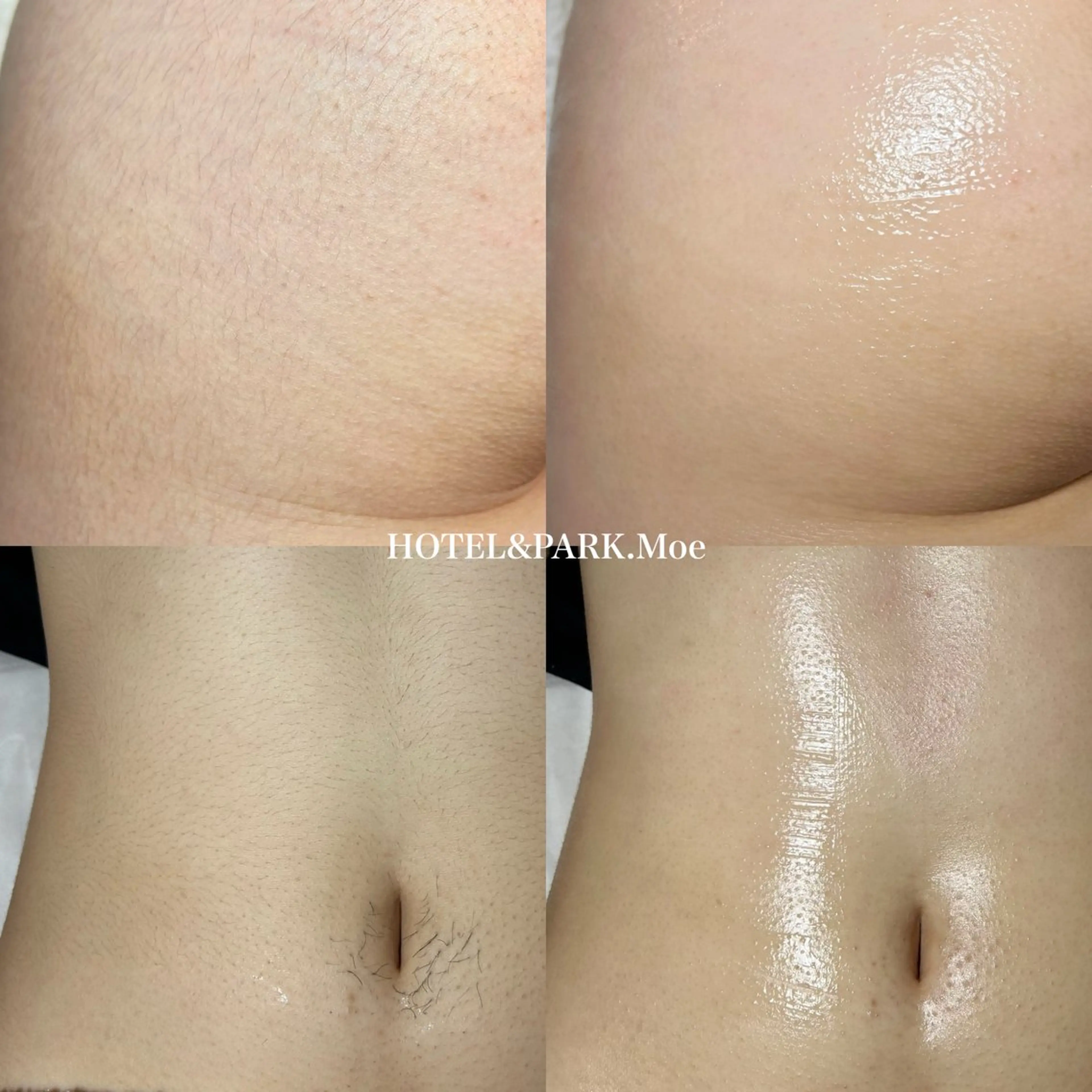 HOTEL&PARK . ワックス脱毛のエステ・リラクイメージ