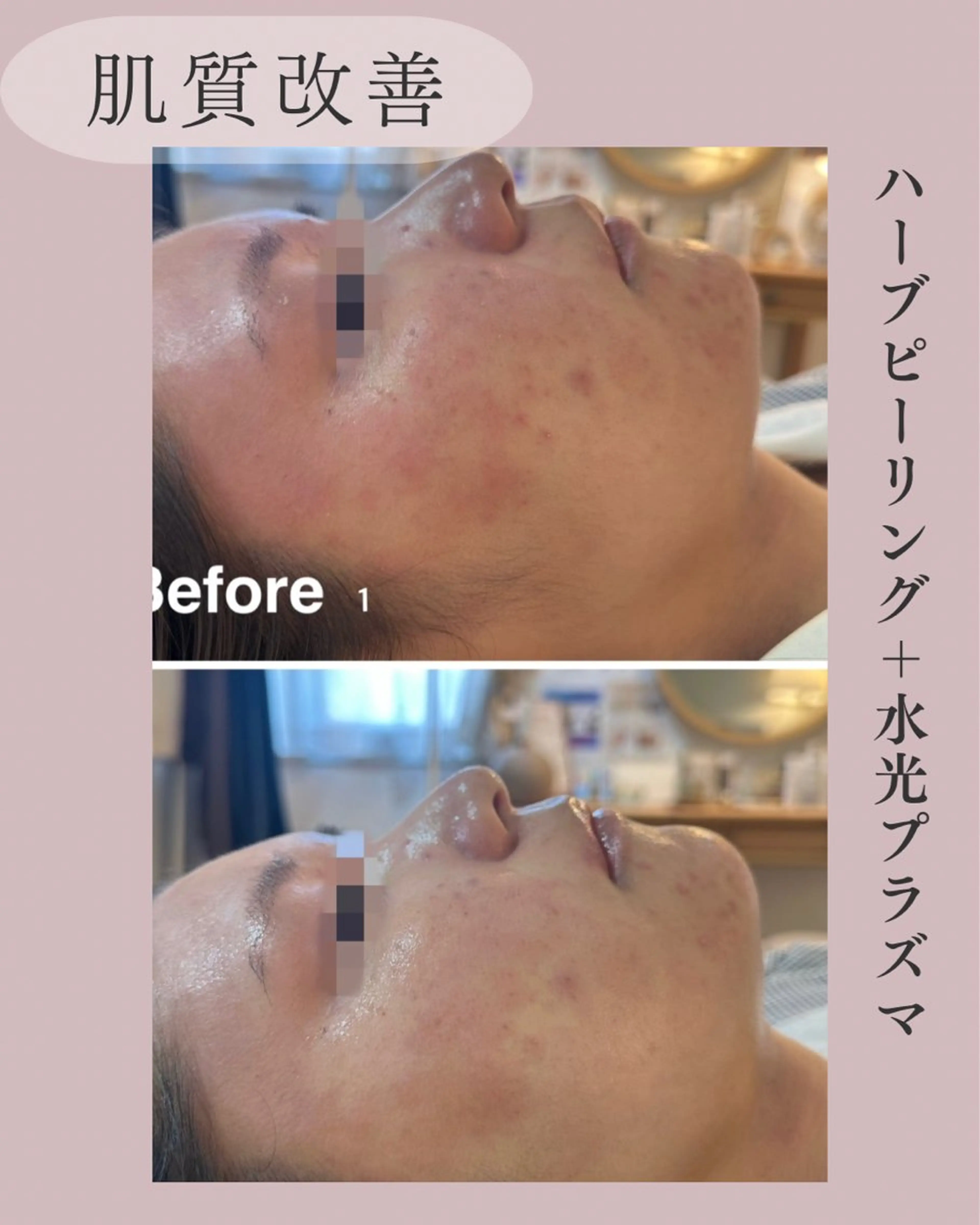 小顔＆肌質改善 NICORIのエステ・リラクイメージ