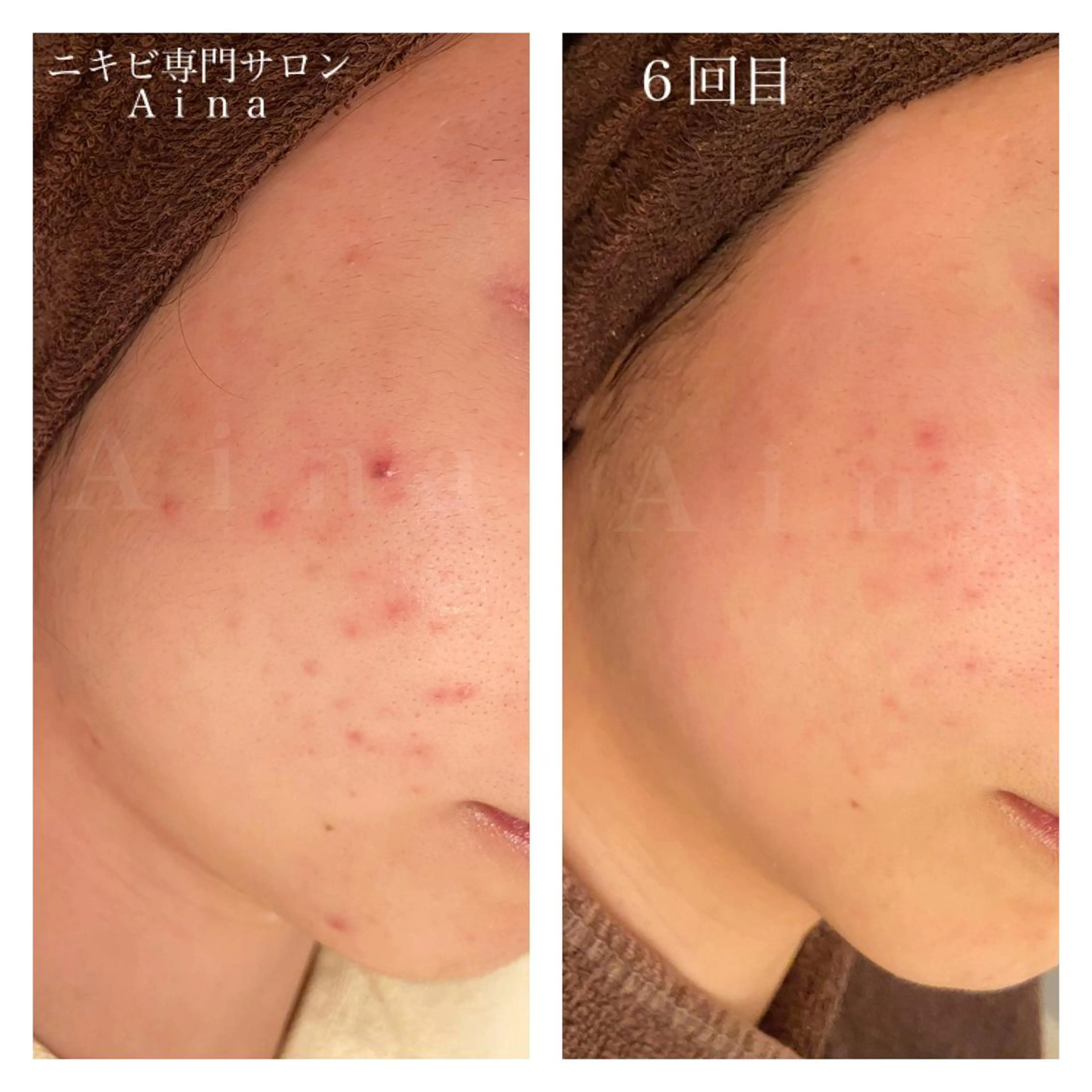 ミディアム カラー パーマ ヘアアレンジ メンズ キッズ ネイル マツエク・マツパ ニキビ跡専門サロン Ａｉｎａのエステ・リラクイメージ