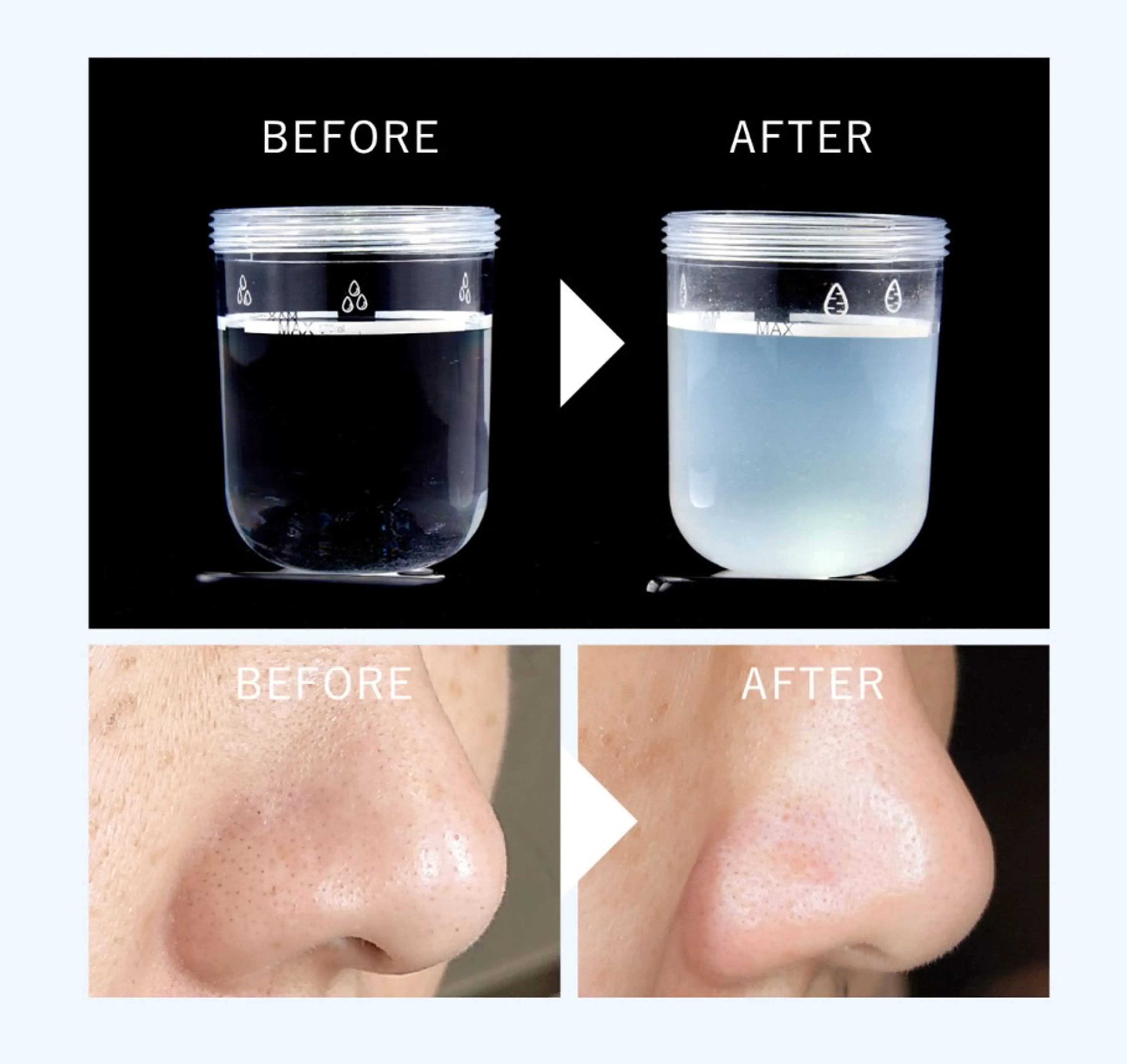 【毛穴黒ずみ】ハイドロフェイシャル✨水素洗浄で毛穴の汚れを根こそぎ吸引!!パスリルにて鎮静&毛穴引き締めツルツル美肌に✨の写真