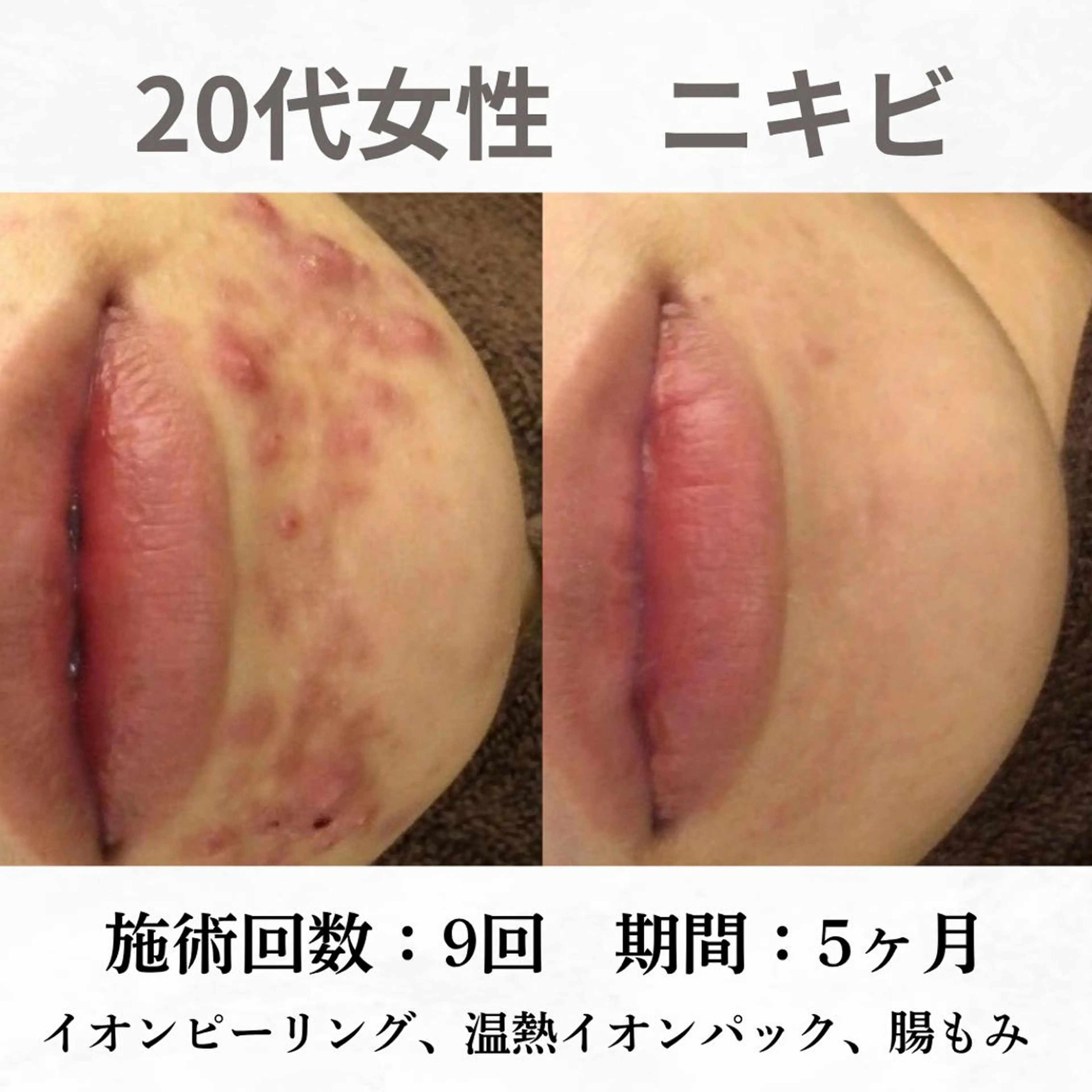 重度ニキビ専門🌷 ダウンタイムなしのエステ・リラクイメージ