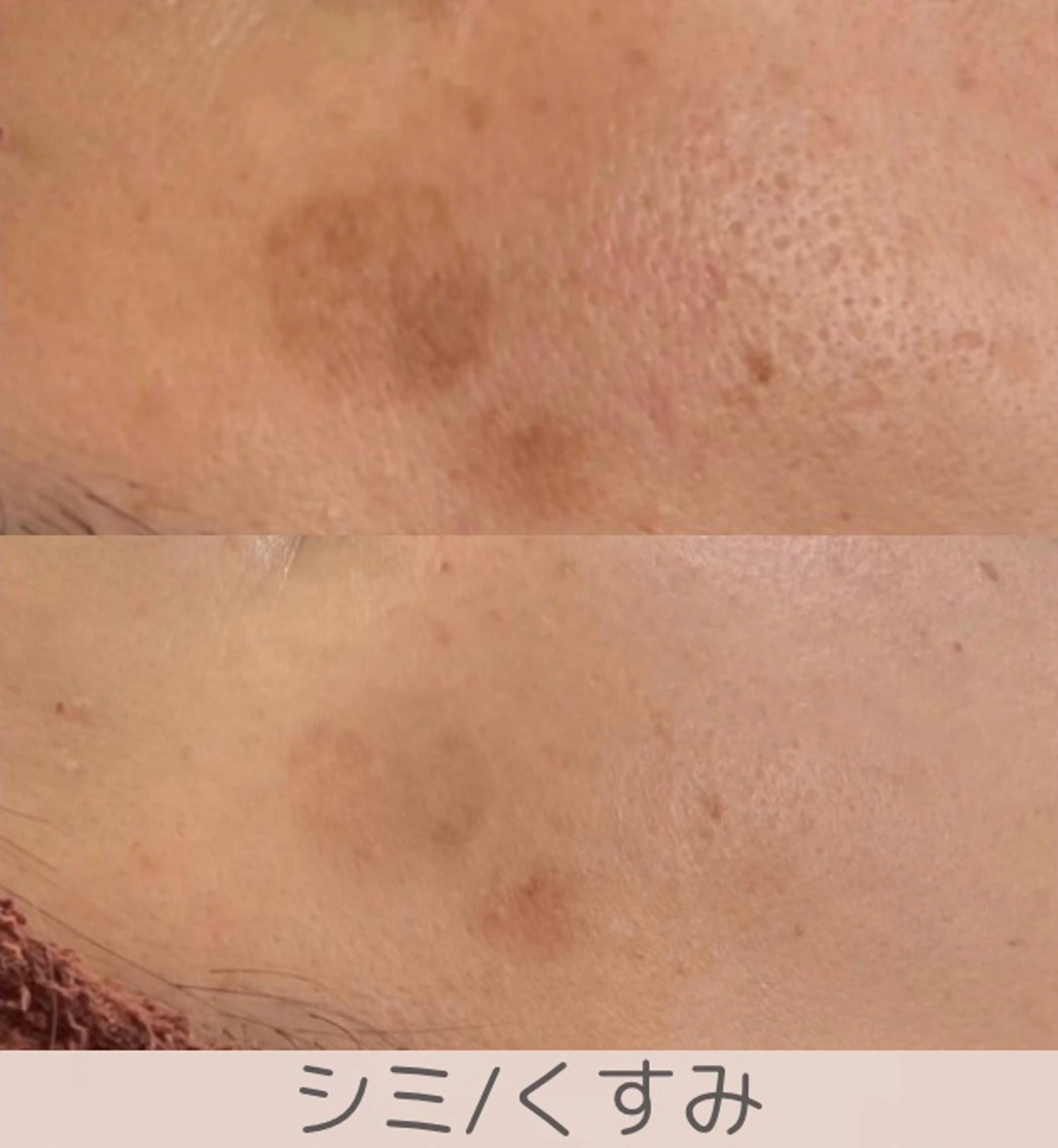 小顔/毛穴/ニキビ salon bealのエステ・リラクイメージ