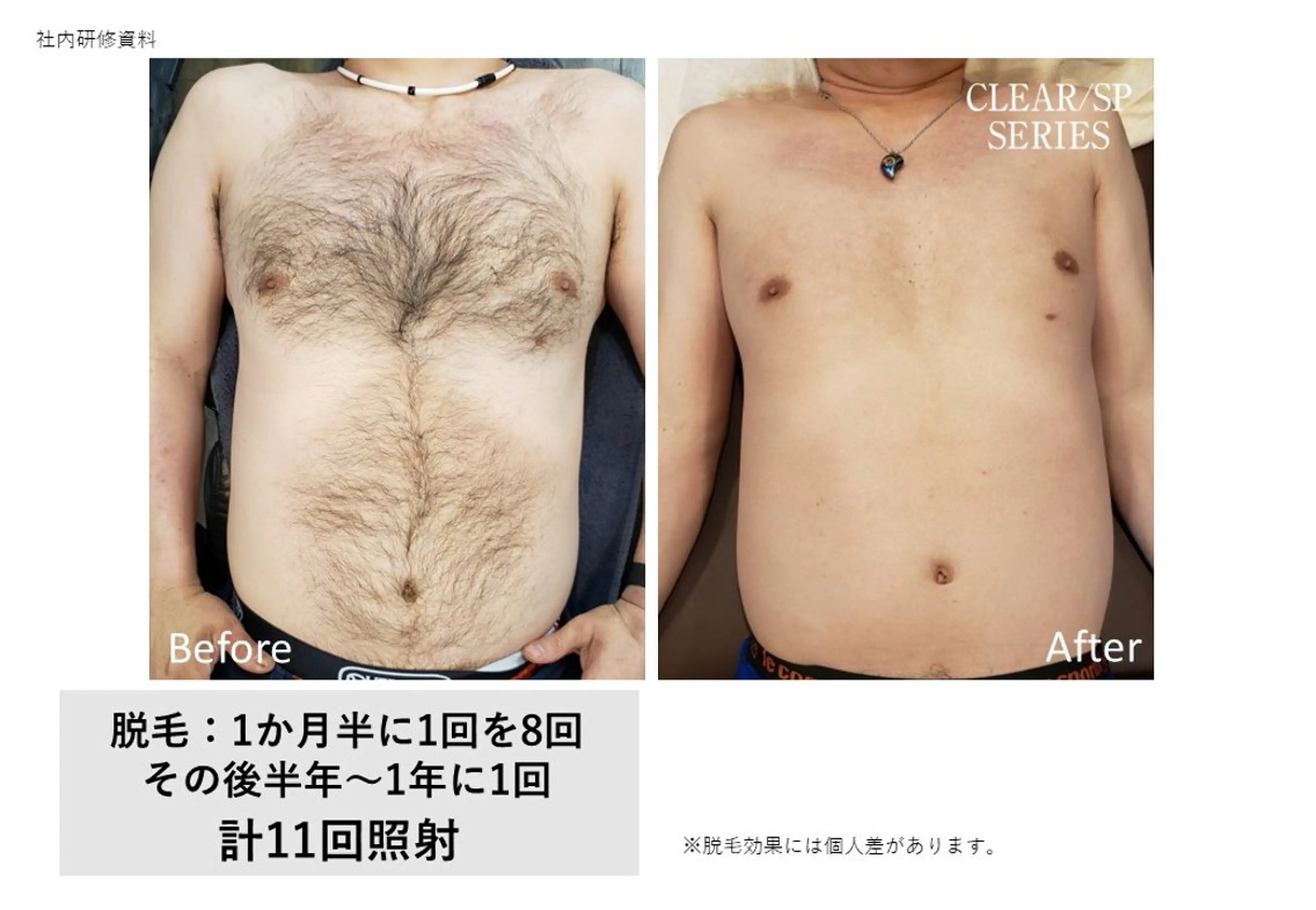 全身脱毛の写真