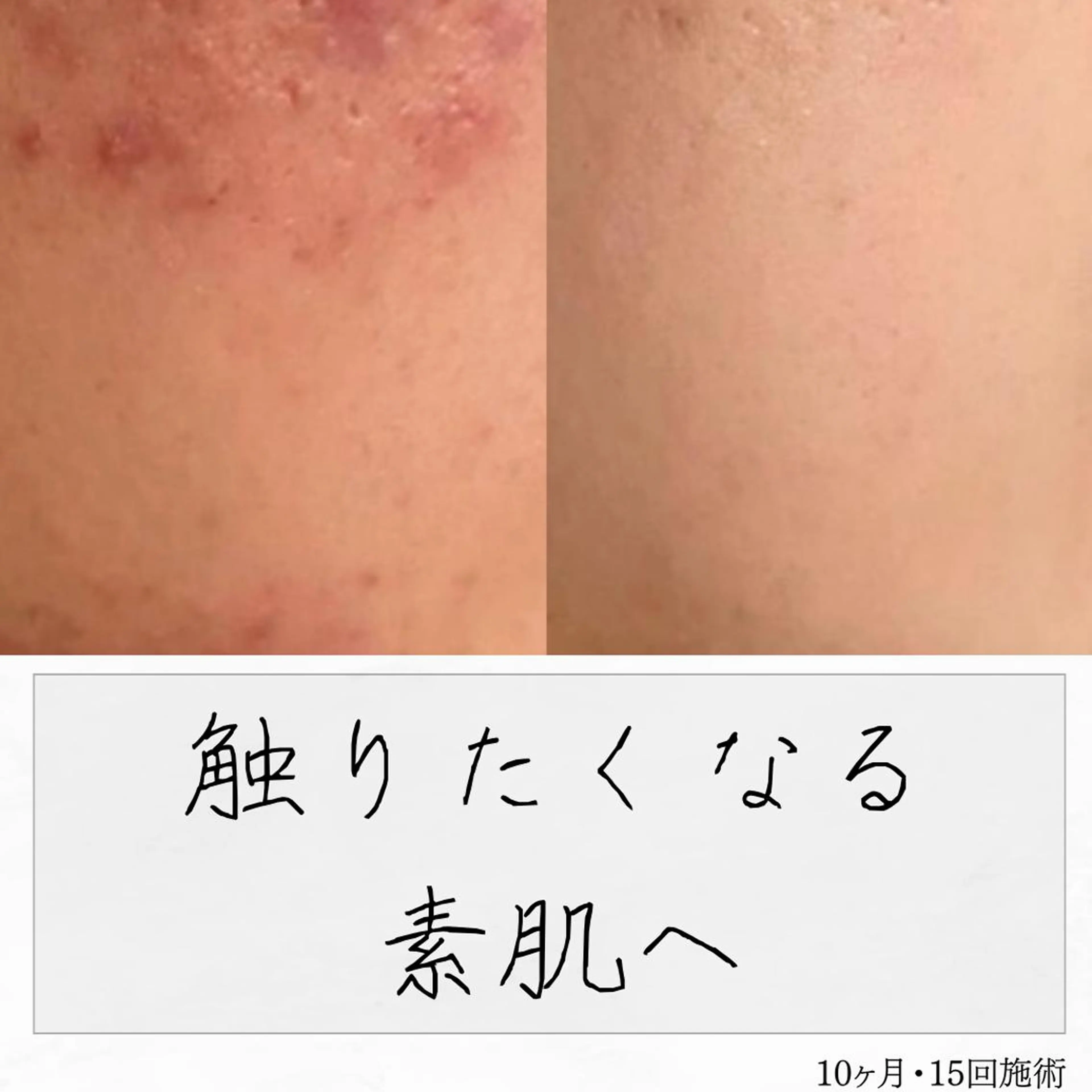 ニキビ経験者が施術 する専門サロン🌻のエステ・リラクイメージ