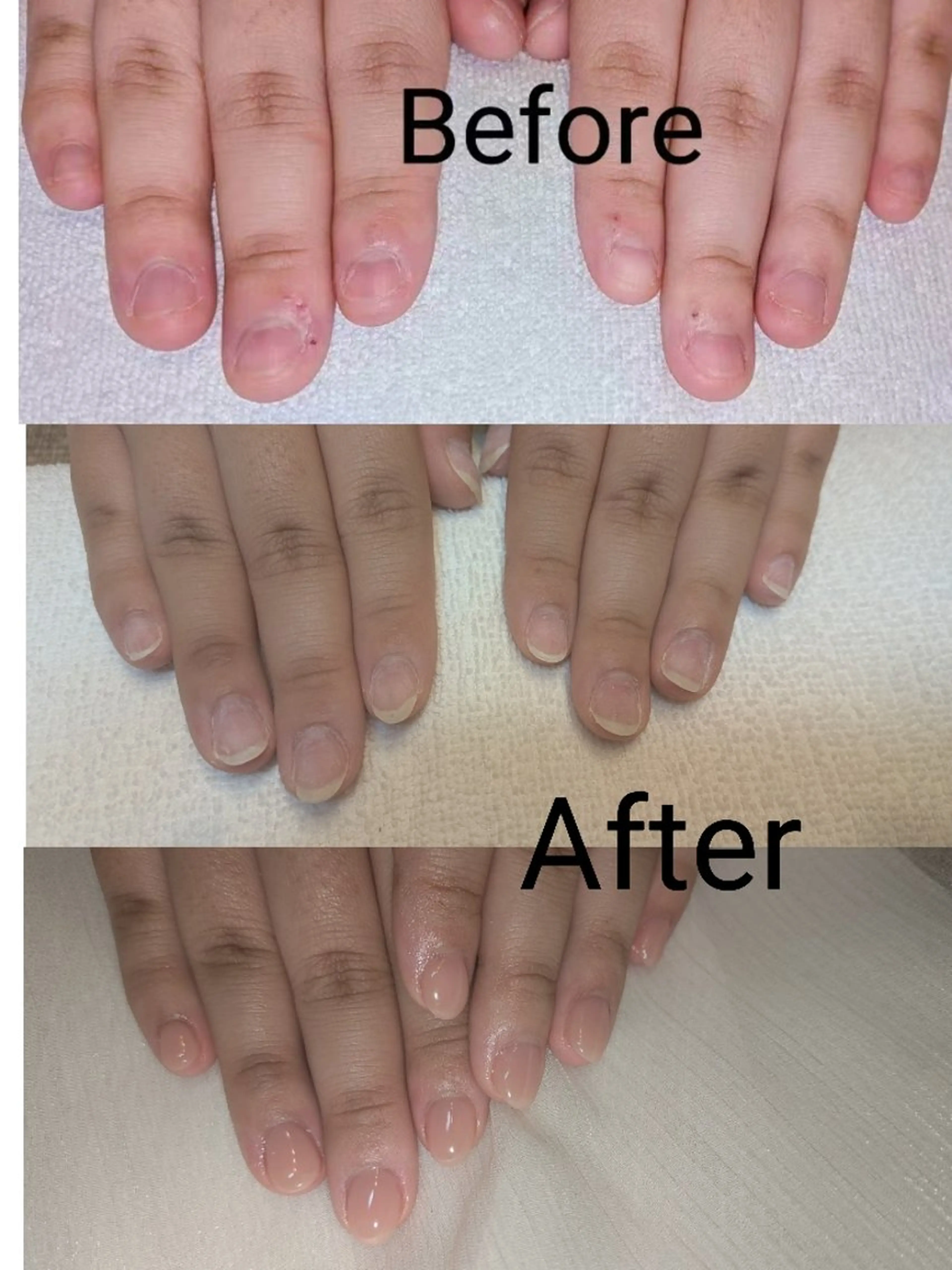 ​【3ヶ月集中】深爪矯正・自爪育成プログラム（全5回）✨長さ出し10本・オフ込み✨39,800の写真