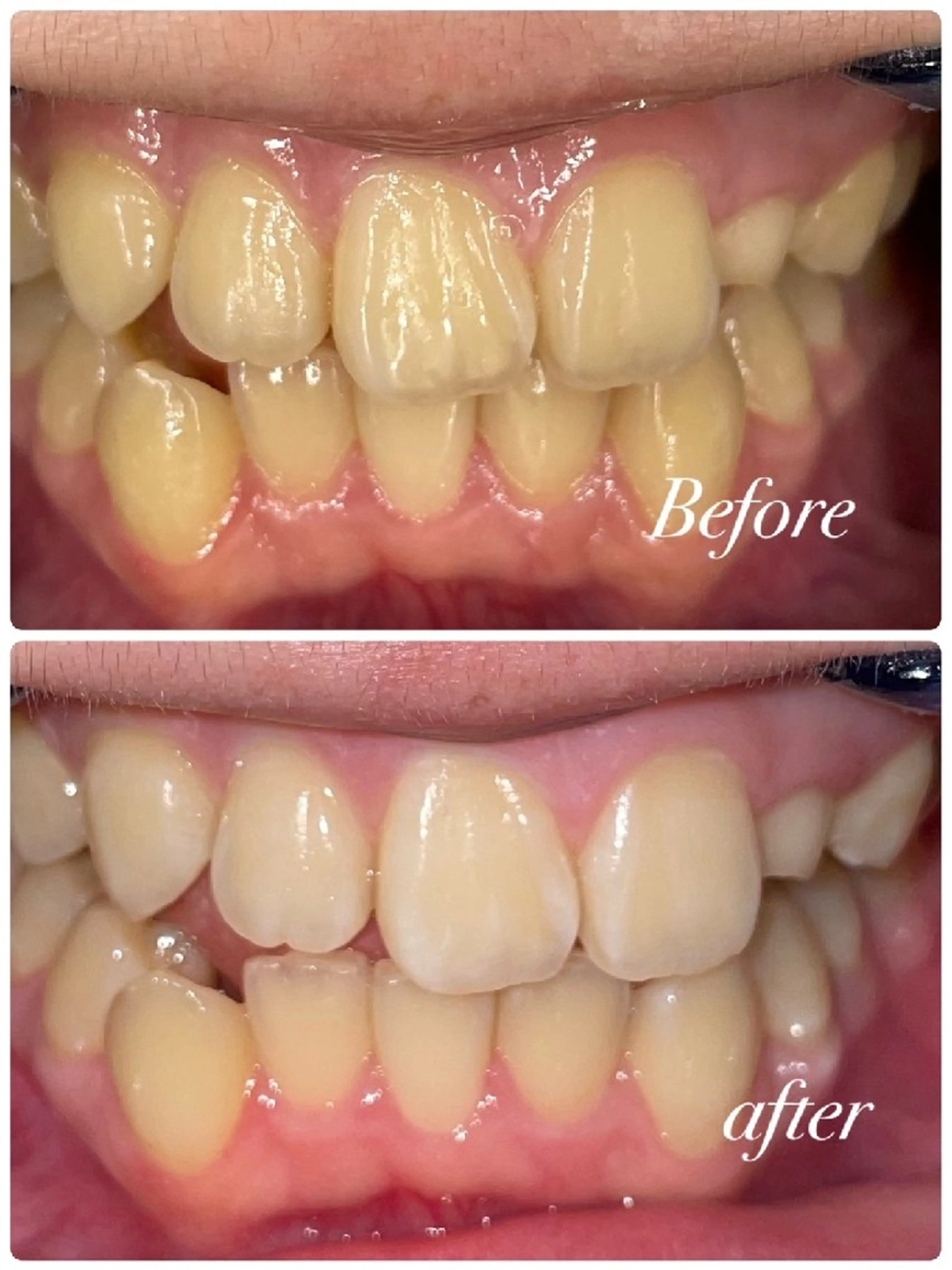 【高校生限定】ディープホワイトニング30分×2来店✨の写真