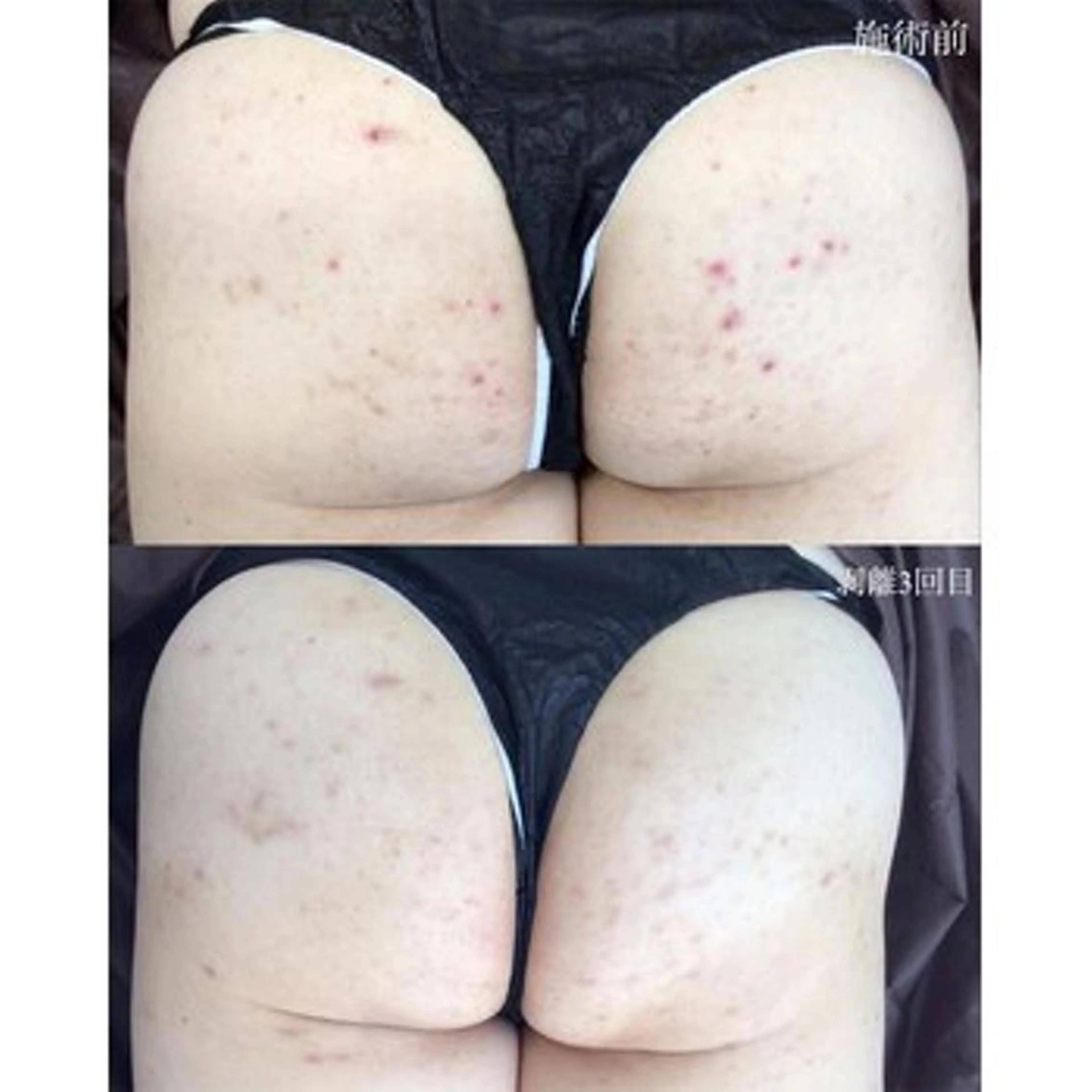 【お尻ハーブピーリング】ニキビケア・毛穴に★(剥離ありor剥離なし選択可）※Google口コミ必須の写真