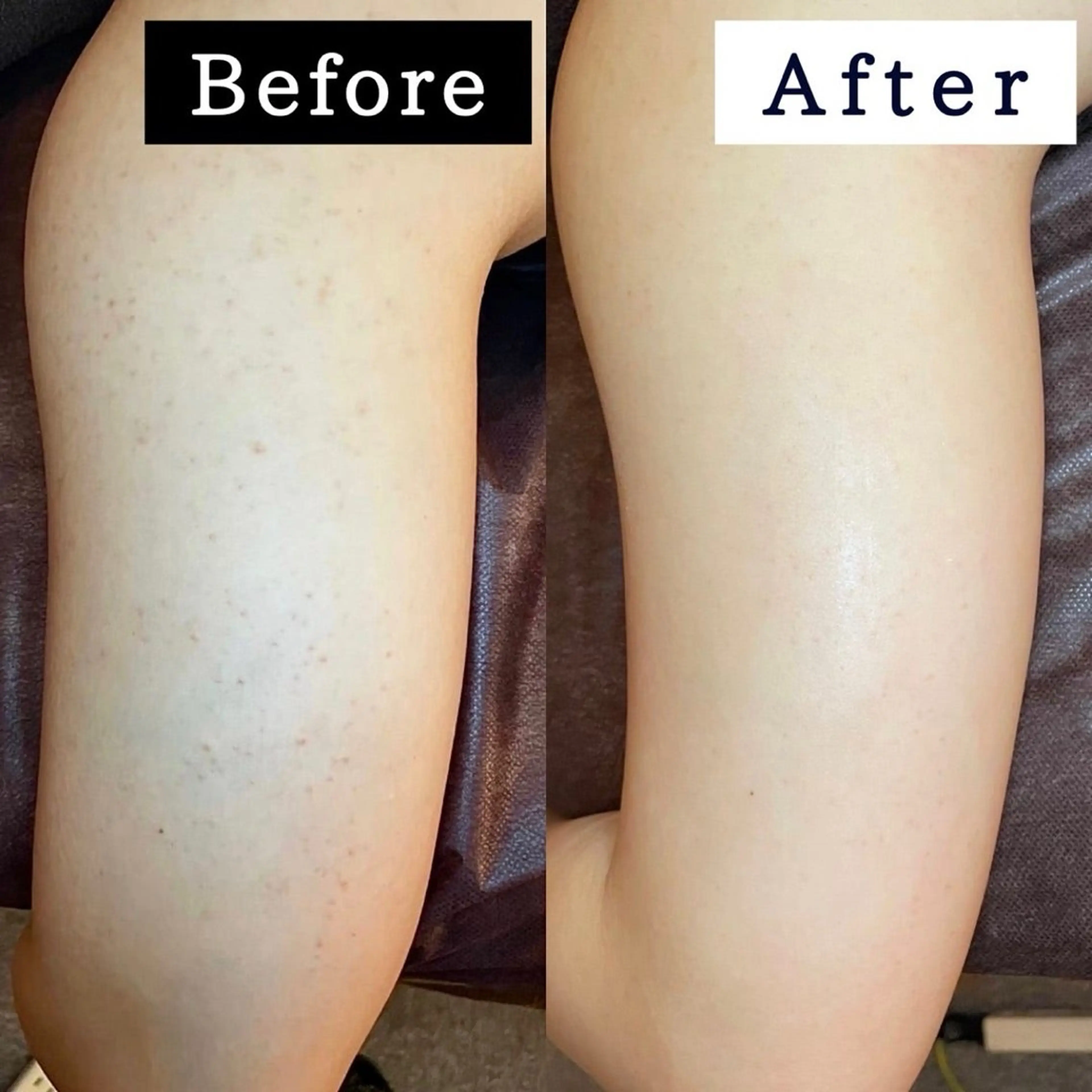 触りたくなる二の腕へ！二の腕もハーブピーリングで、引き締めツルツルで、キュッとした、触っていたくなる肌を作りましょう！の写真