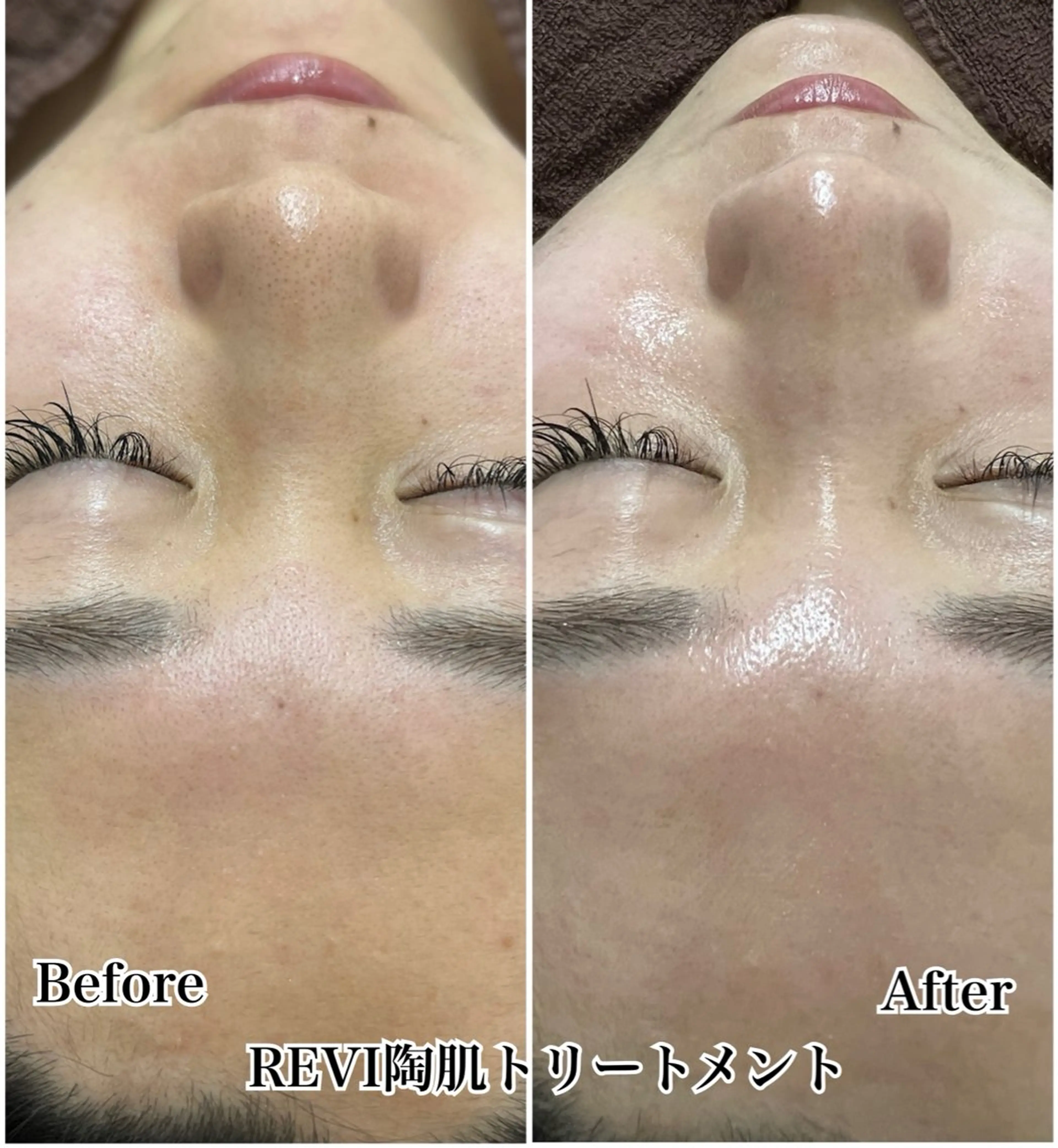 【美肌×コルギ】REVI陶肌トリートメント＋デコルテor頭コルギ15分の写真