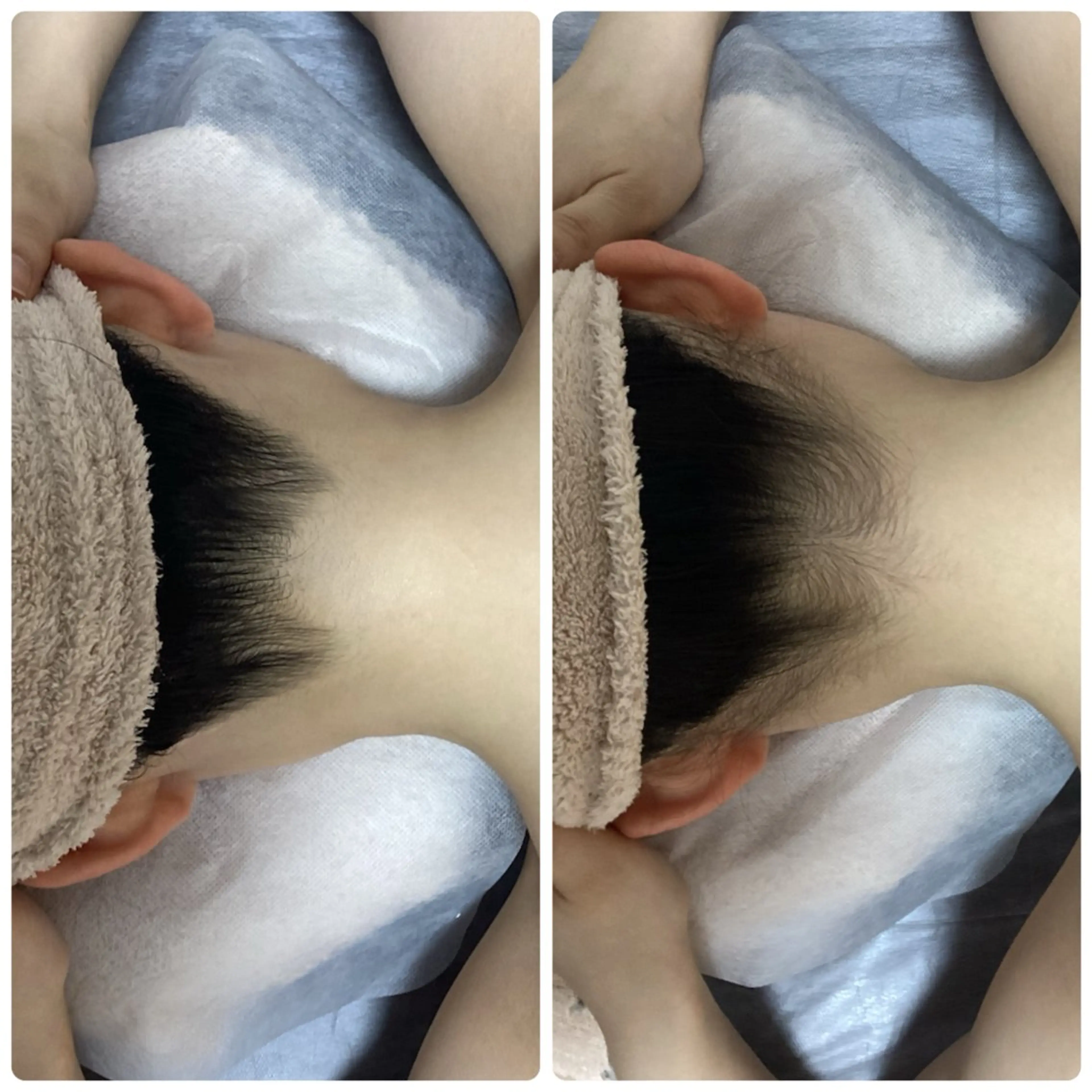 【人気No. 1⭐︎】《女性◆IPL脱毛》うなじ脱毛1回¥3990の写真